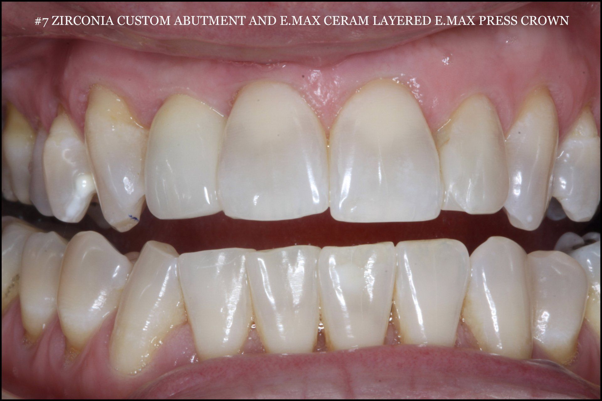 A close up of a person 's teeth with the words zirconia custom adjustment and max clean latexed max press crown