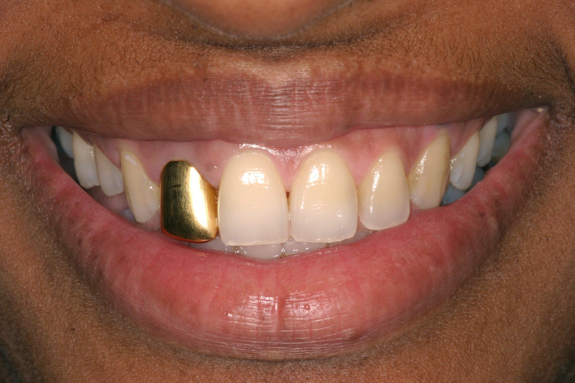 A close up of a person 's teeth with a gold tooth.