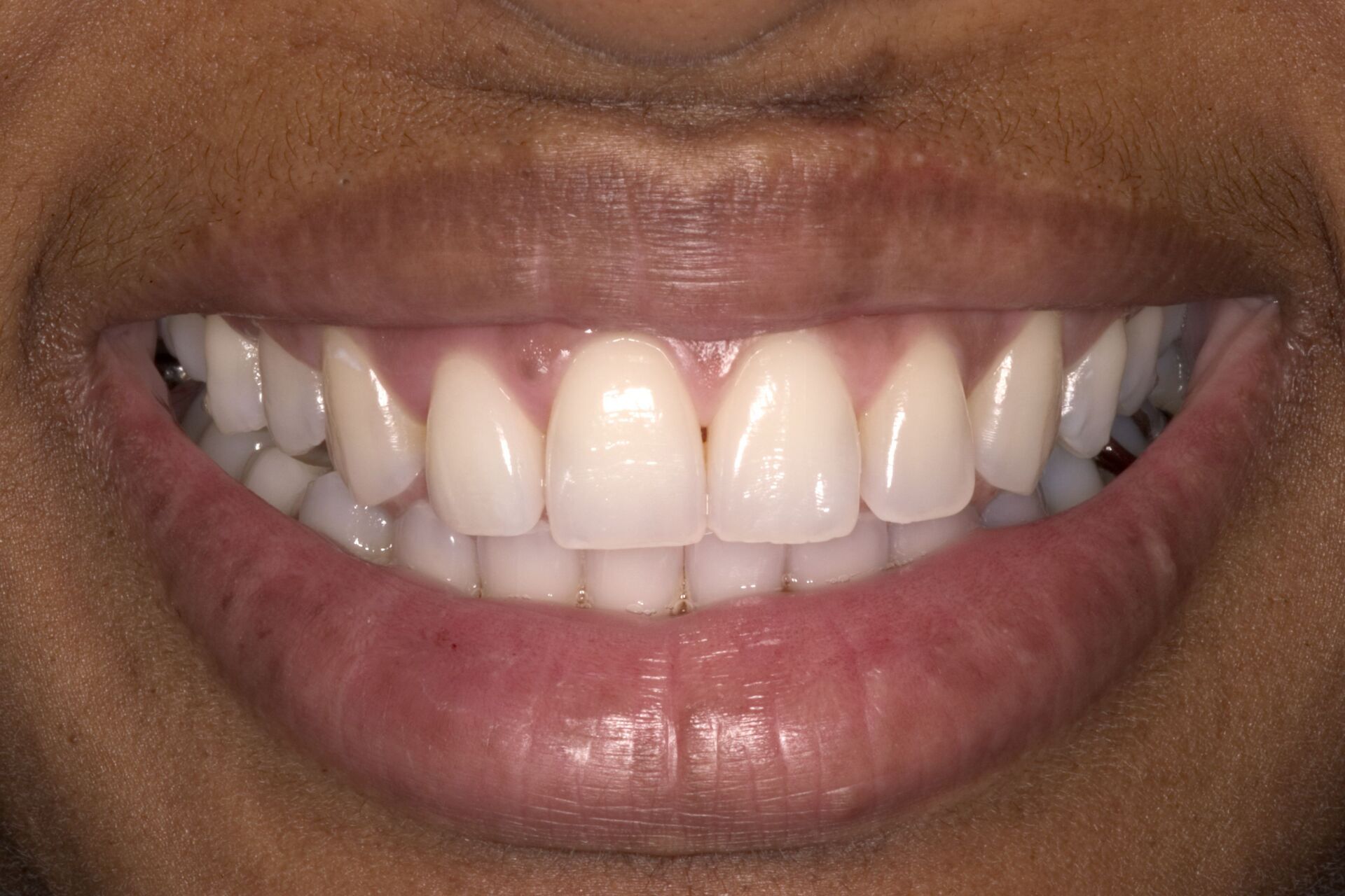 A close up of a person 's mouth with white teeth.