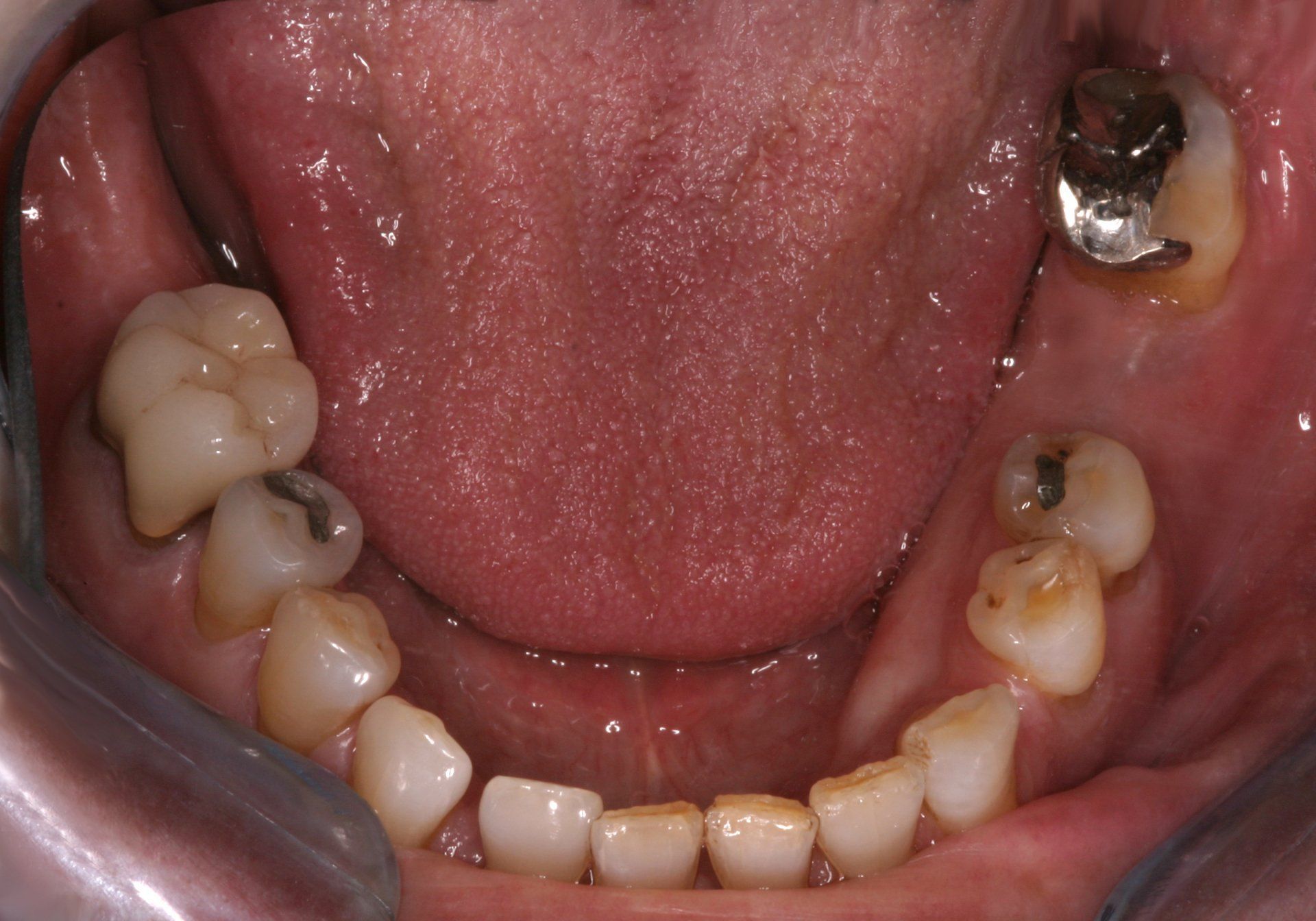 A close up of a person 's mouth with a lot of teeth