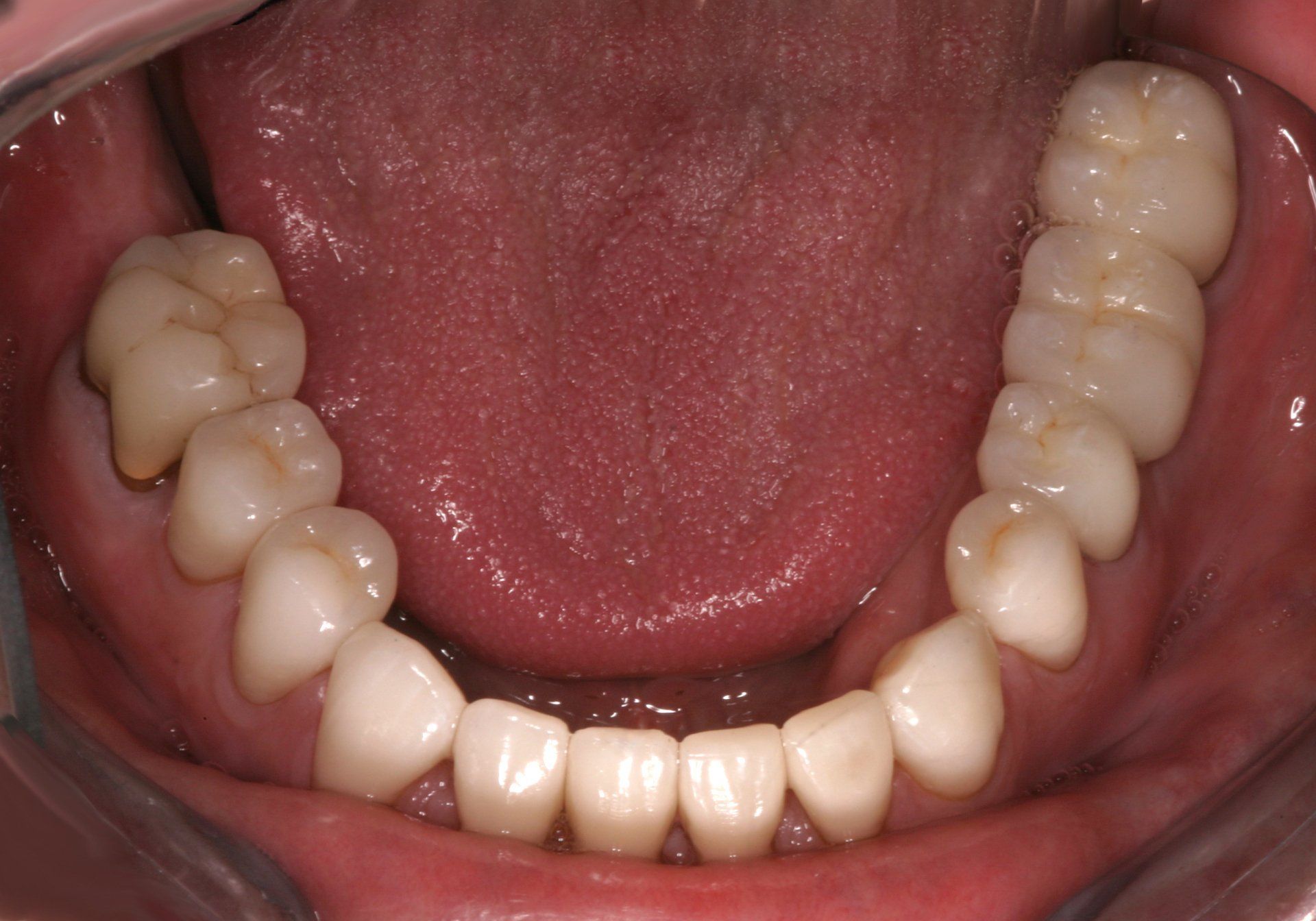 A close up of a person 's teeth with dental braces.