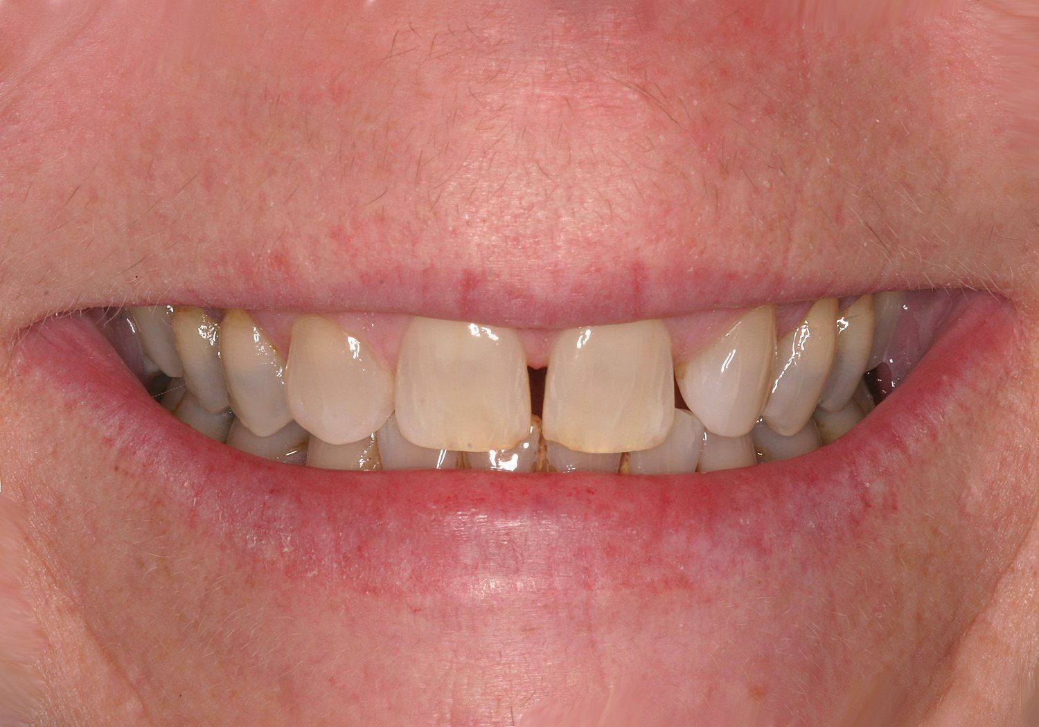 A close up of a person 's teeth with a missing tooth.