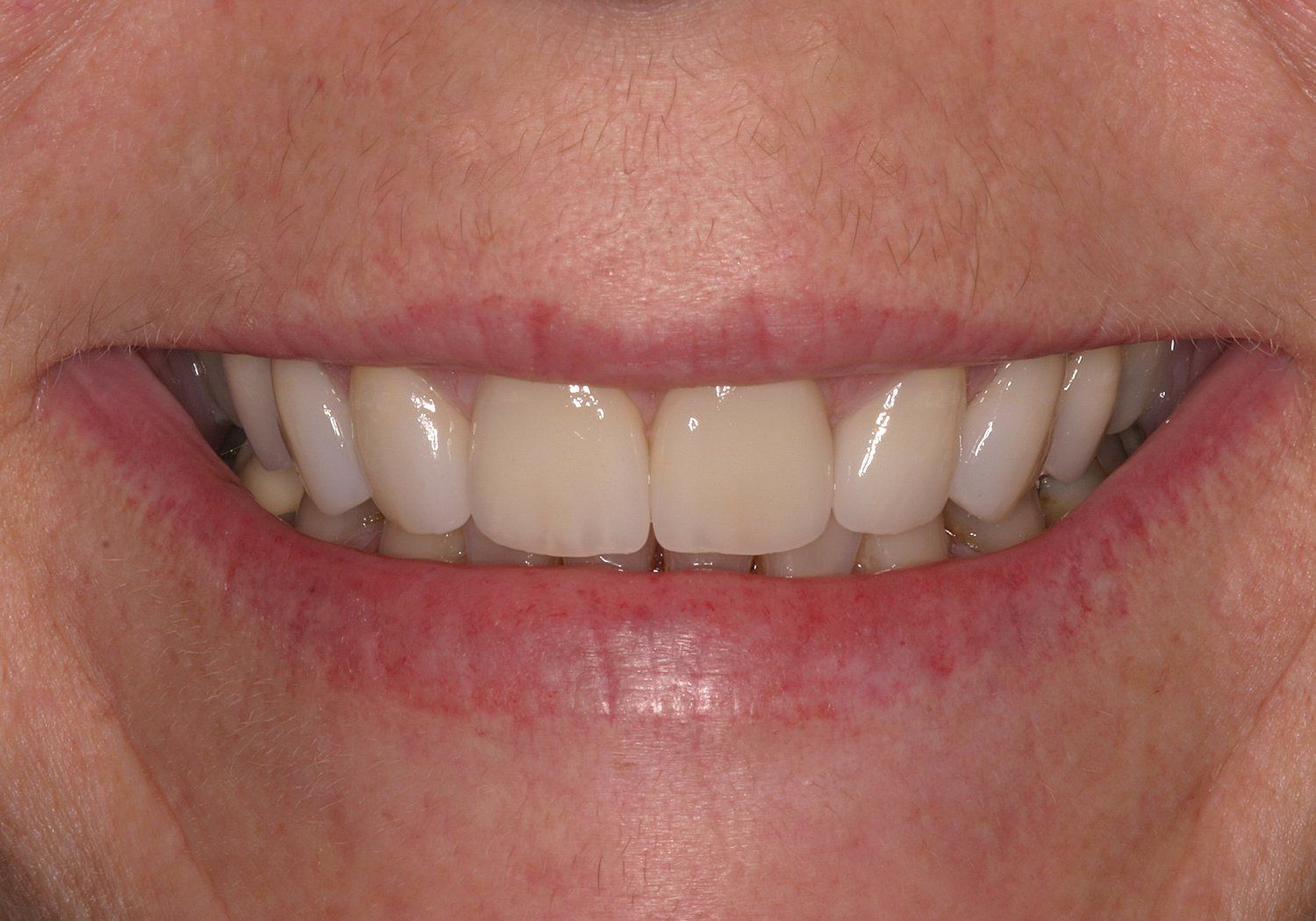 A close up of a woman 's smile with white teeth.