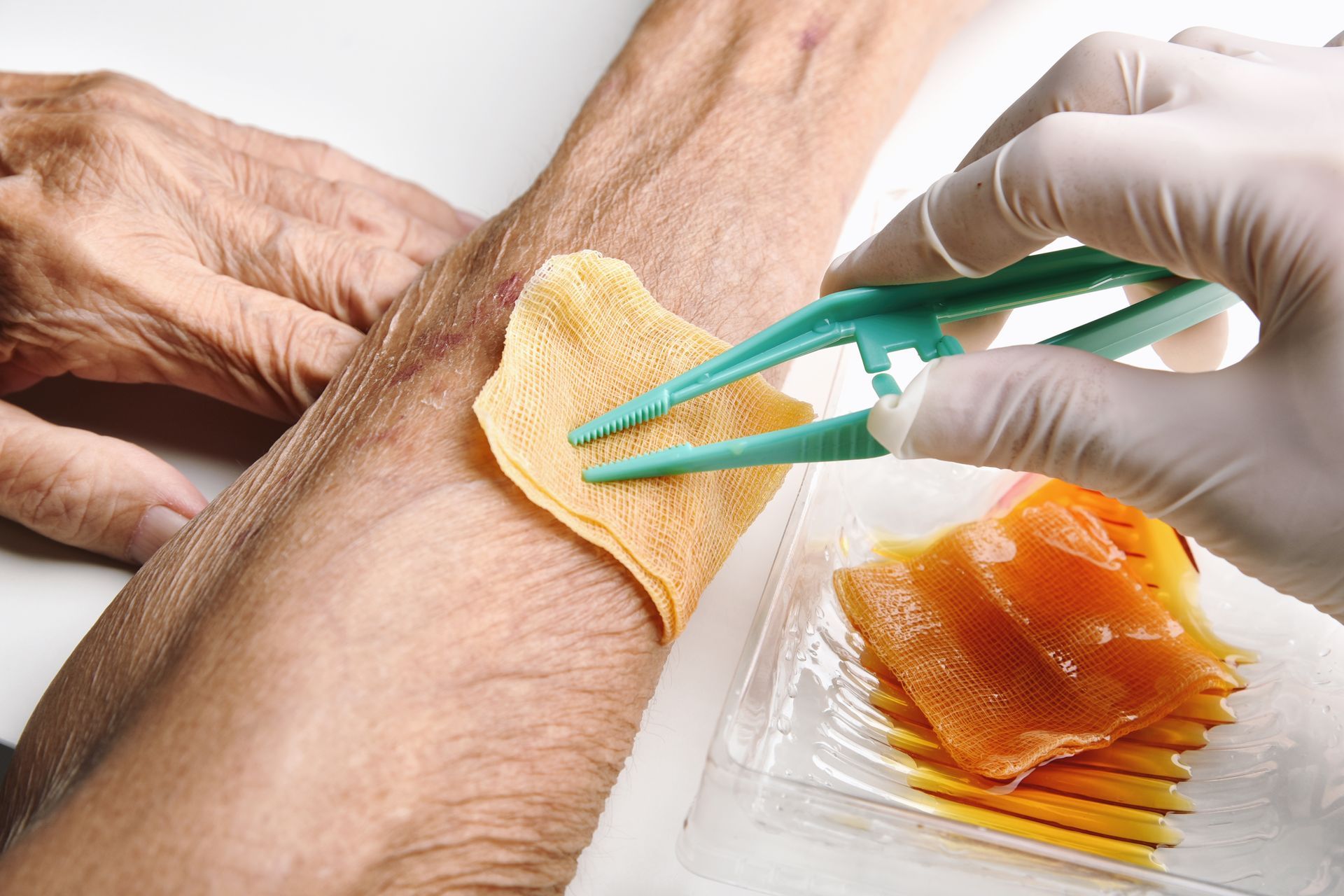 A close-up of a gloved hand dressing a wound with normal saline and povidone iodine.