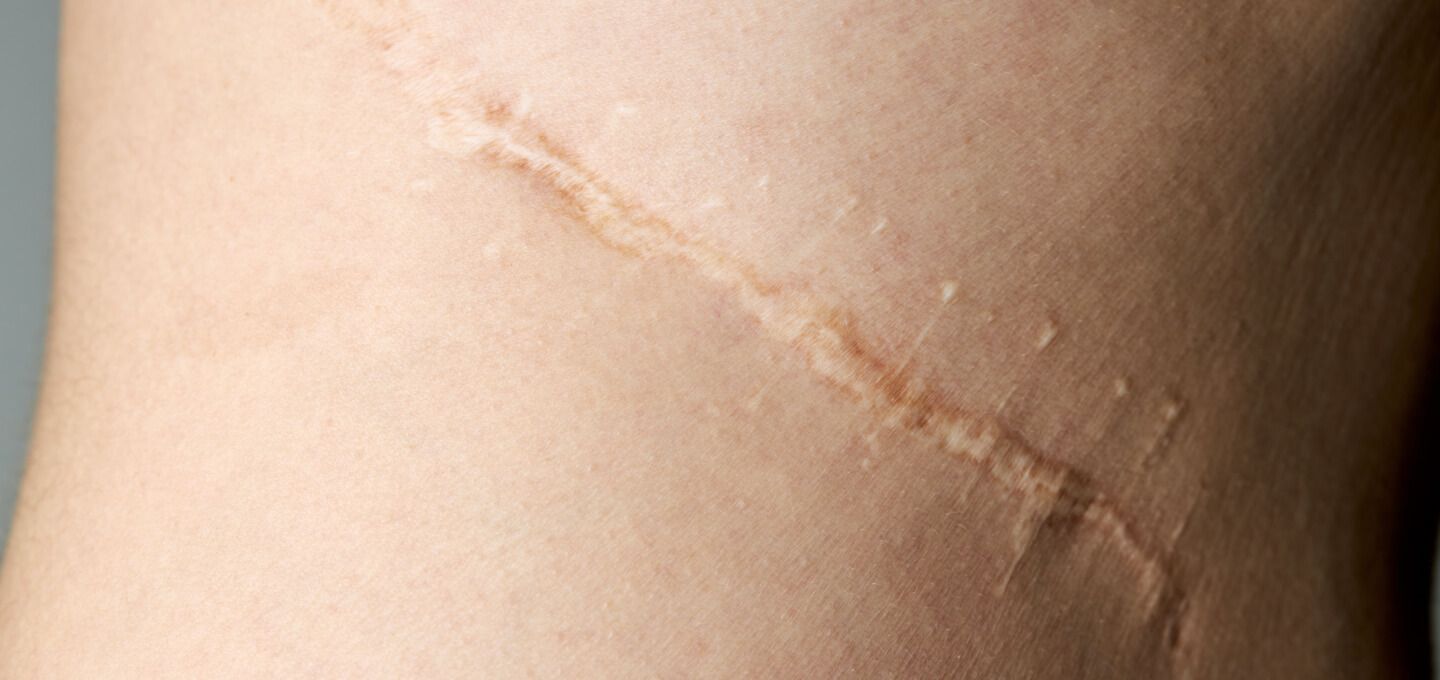 A close up of a person 's arm with a scar on it.