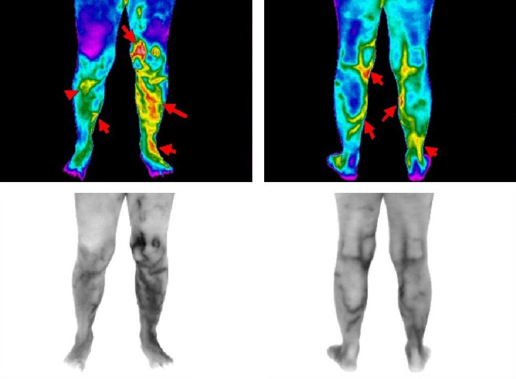 Thermography image DVT viewed in left leg