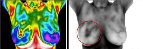 A woman 's breasts are shown in a thermal image and in a black and white image.