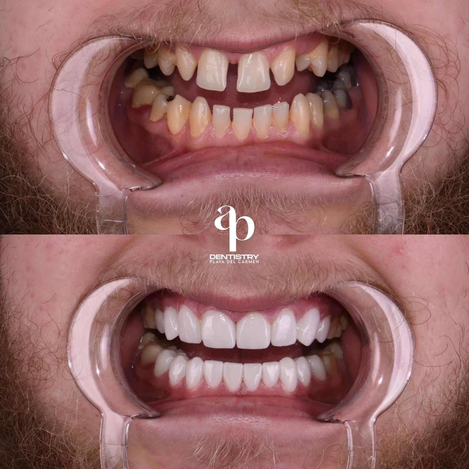 Dental Crowns in Mexico 