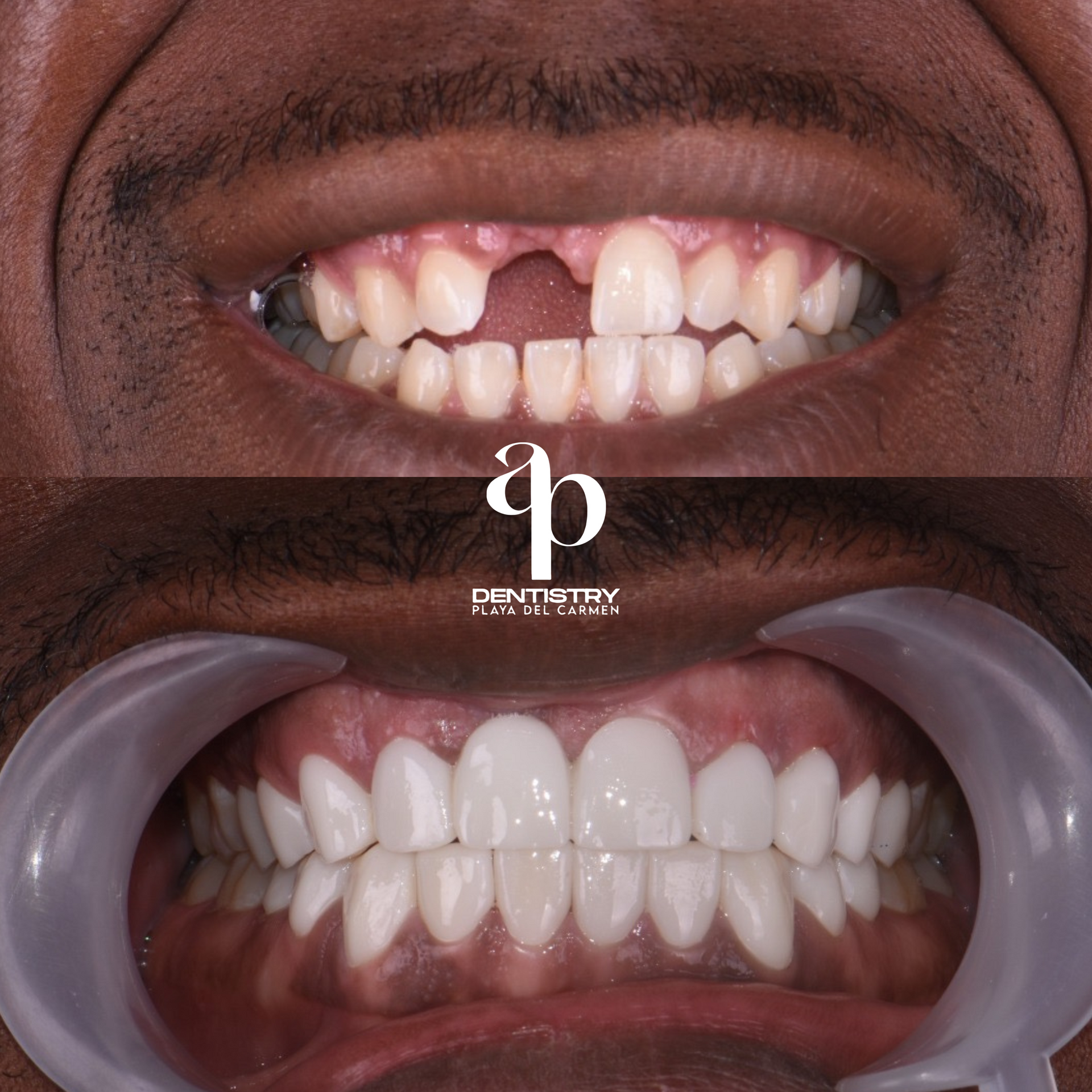 Dental crowns in Mexico