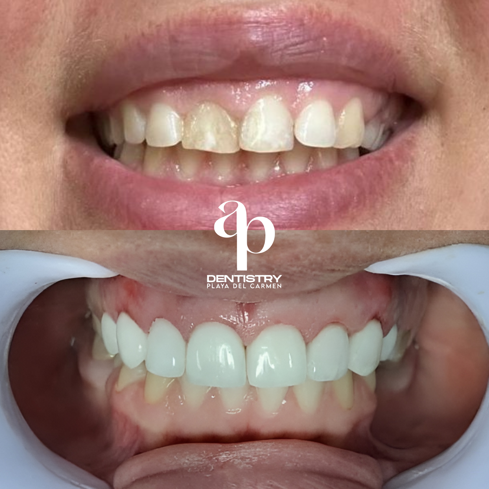 Veneers in Mexico