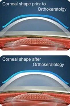 corneal shape