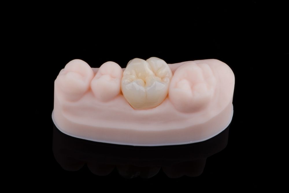 Dental model with a single crown surrounded by pink gums and teeth, against a black background. — AB Esthetic Dental Laboratory in Robina, QLD