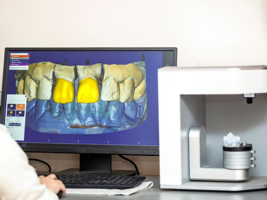 Dental CAD/CAM system: Computer screen displays 3D tooth model with two yellow crowns; a digital scanner is at the right. — AB Esthetic Dental Laboratory in Sunshine Coast, QLD
