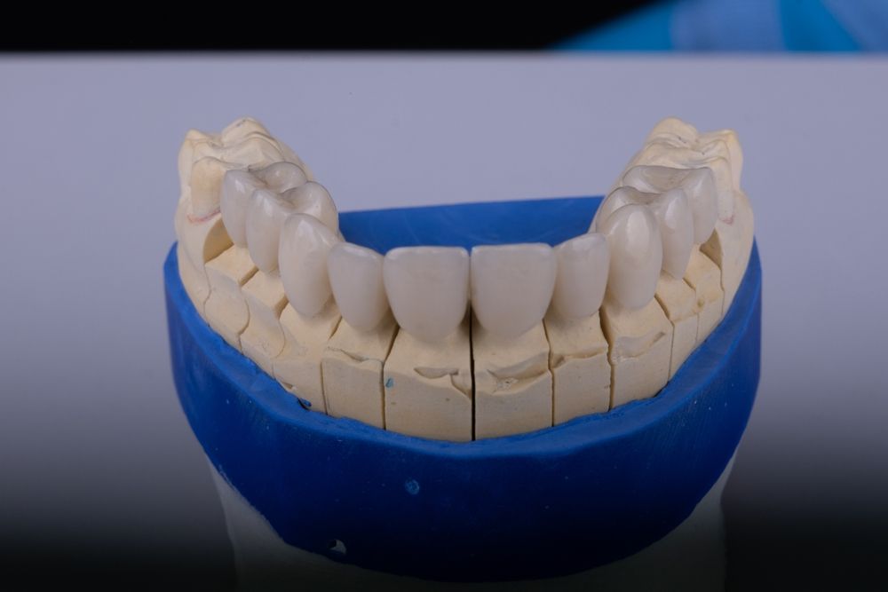 Dental model of upper teeth, white porcelain crowns set in plaster, in a blue holder. — AB Esthetic Dental Laboratory in Robina, QLD