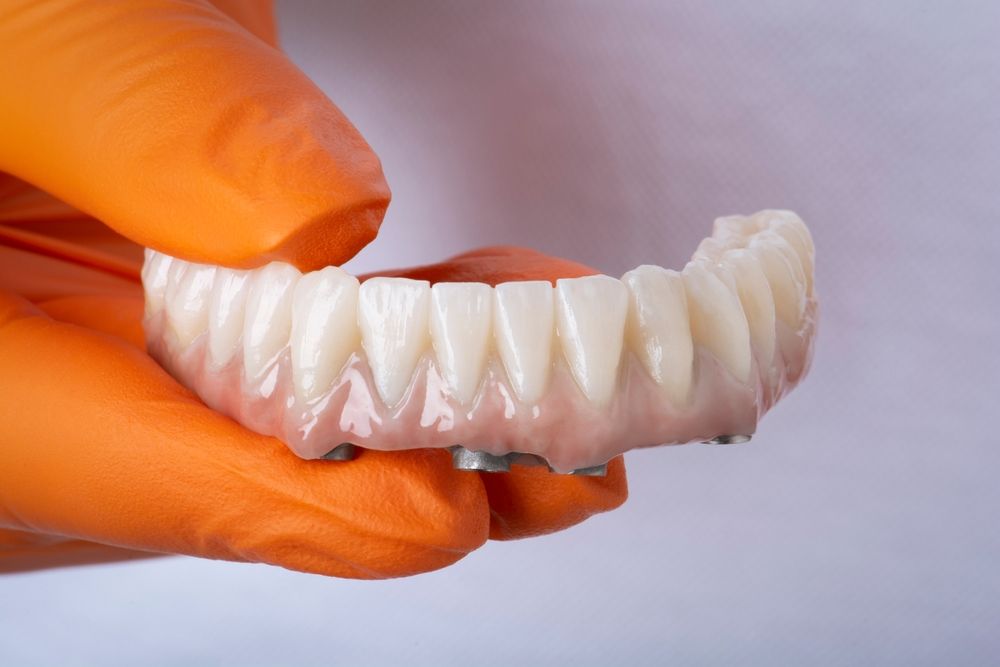 A set of upper dental implants held by an orange-gloved hand against a white backdrop. — AB Esthetic Dental Laboratory in Robina, QLD