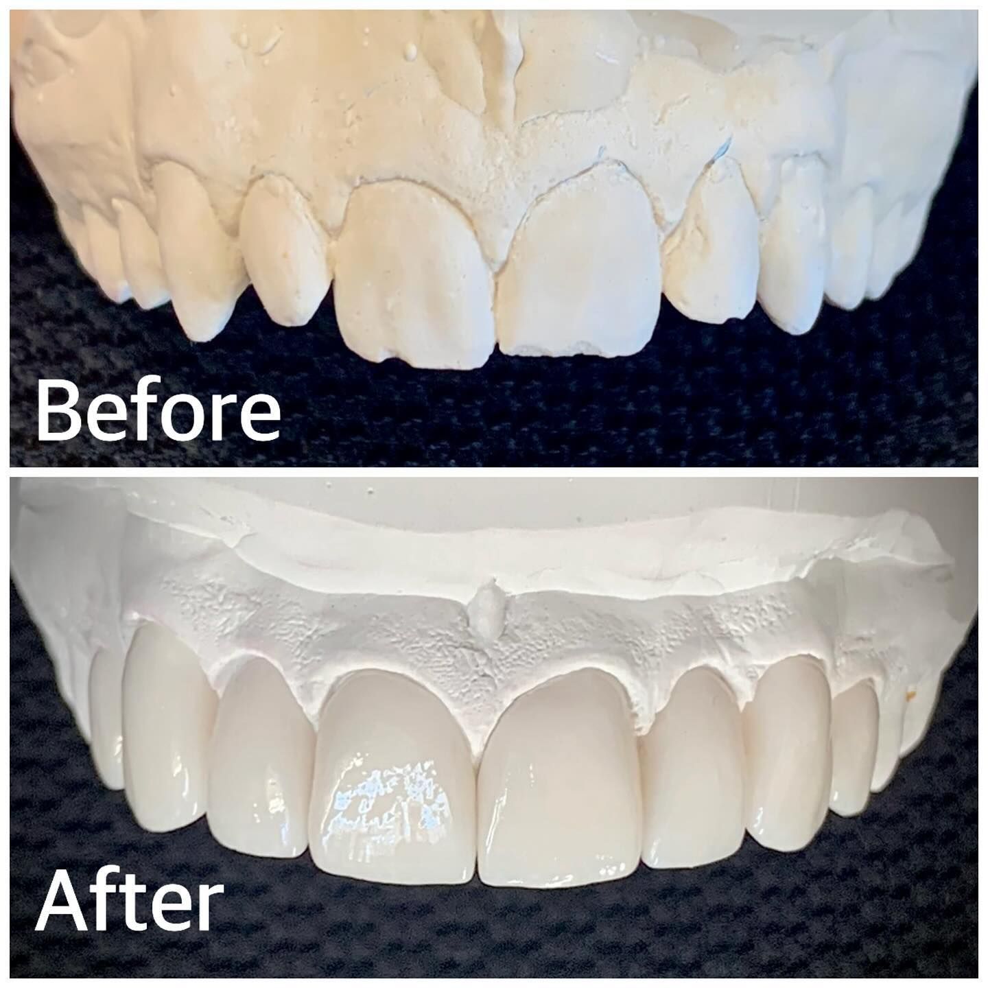Dental Models Showing a Before and After Comparison of Teeth — AB Esthetic Dental Laboratory in Brisbane, QLD