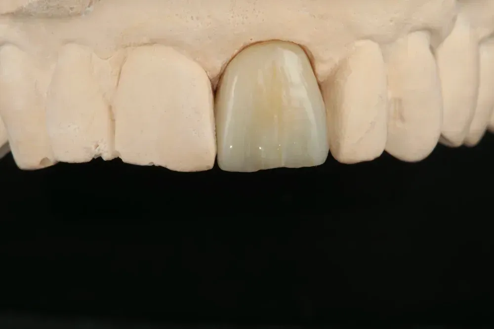 Dental model with a single porcelain crown. — AB Esthetic Dental Laboratory in Robina, QLD