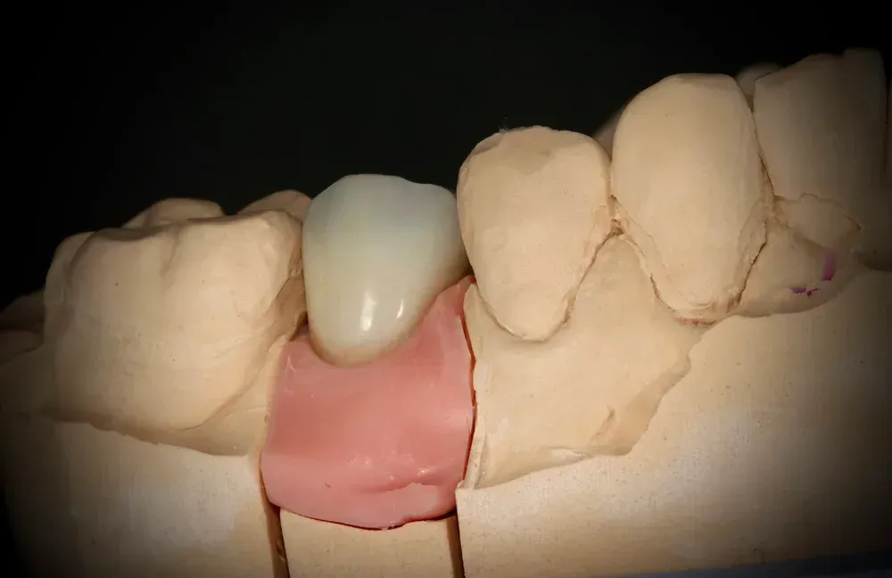 Dental model with a white crown and pink base, surrounded by tan teeth molds. — AB Esthetic Dental Laboratory in Brisbane, QLD