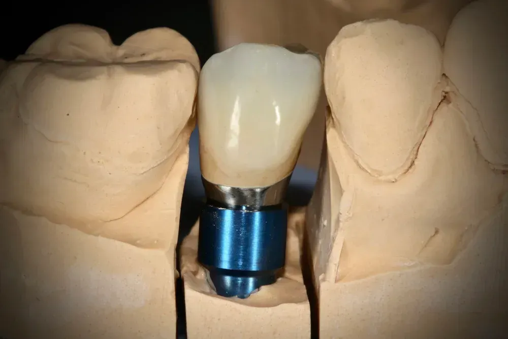 Dental implant with porcelain crown in model. Blue implant post visible. — AB Esthetic Dental Laboratory in Robina, QLD