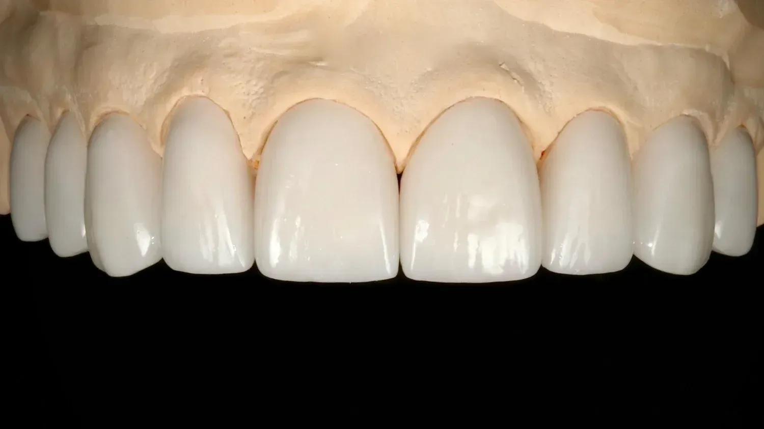 Person Inserting Clear Dental Aligner Into Mouth