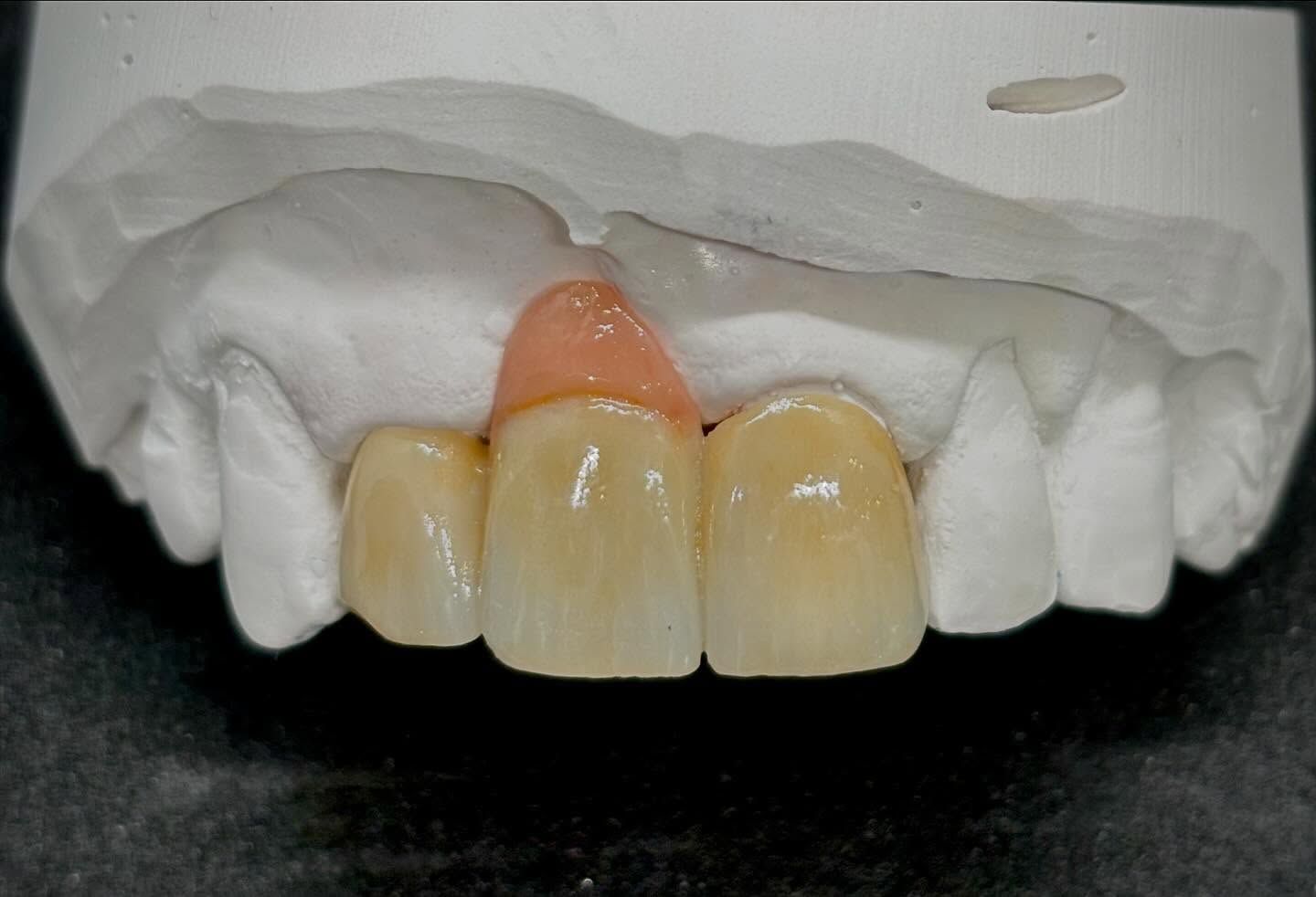 Dental model with three prosthetic teeth and pink gum restoration. — AB Esthetic Dental Laboratory in Sunshine Coast, QLD
