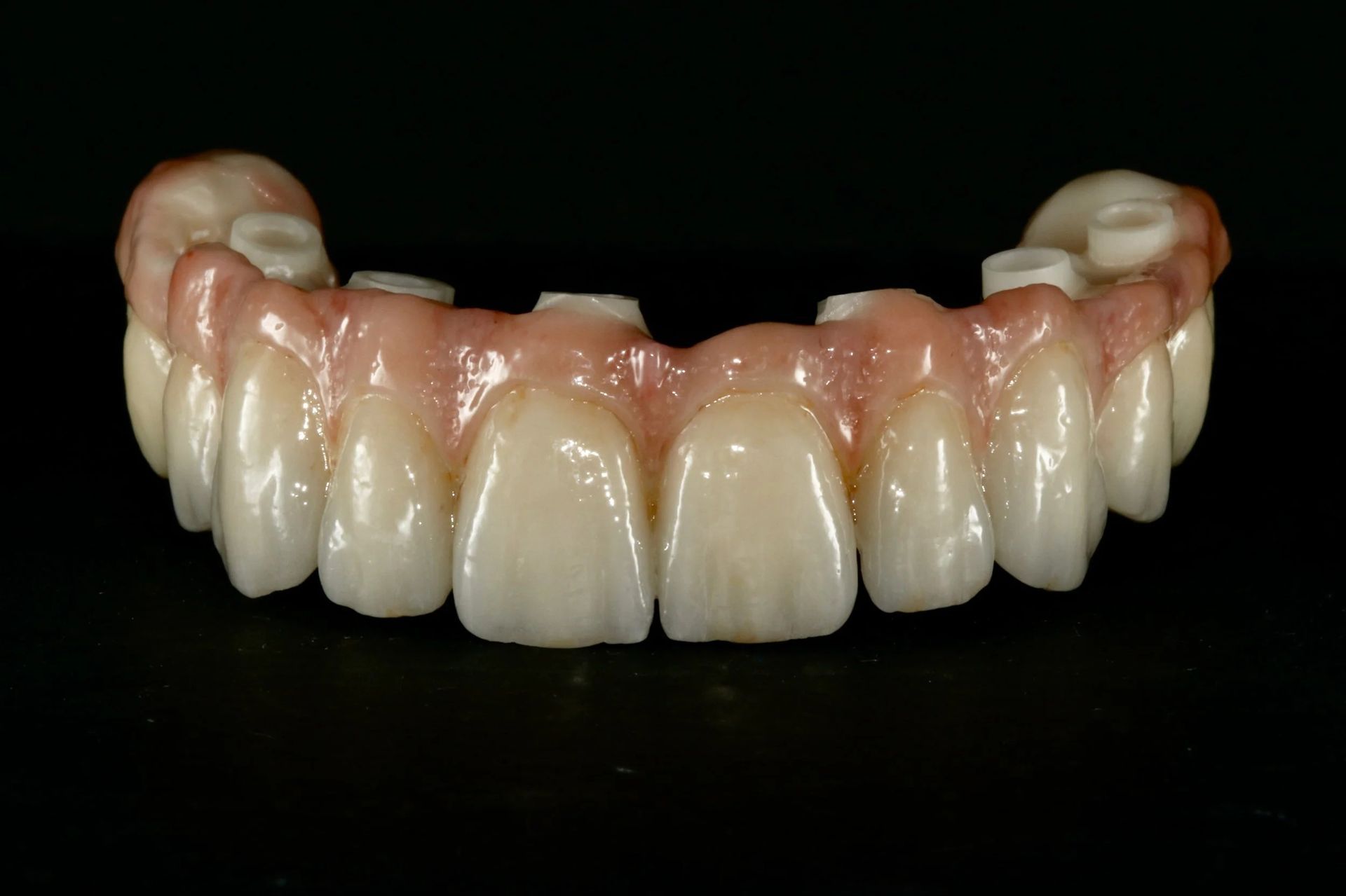 Upper Dental Prosthesis With Porcelain Teeth — AB Esthetic Dental Laboratory in Sunshine Coast, QLD
