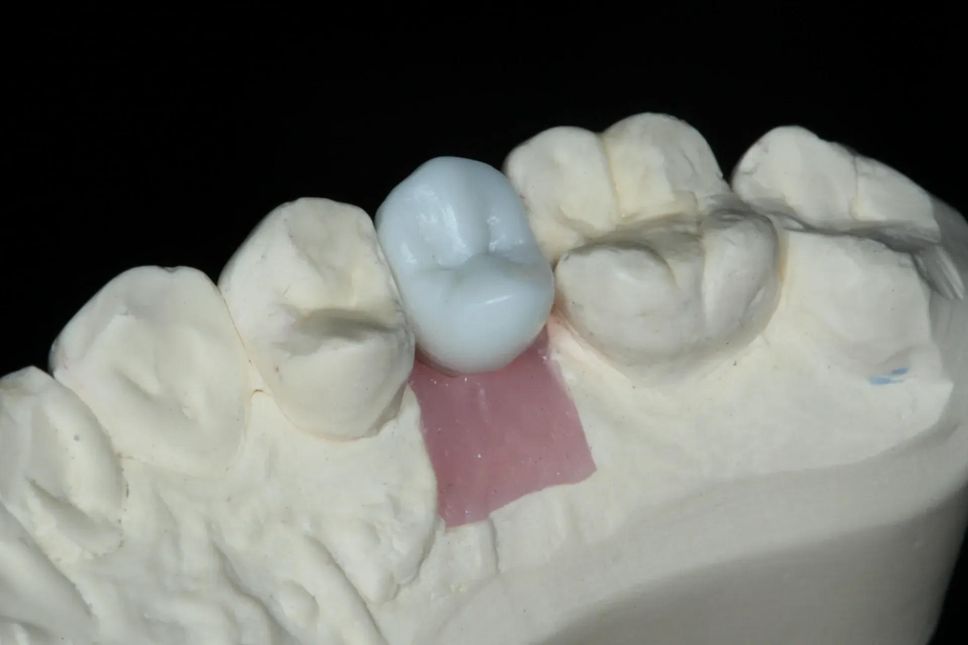 Red wax dental crowns on a gray post, showing dental work in progress. — AB Esthetic Dental Laboratory in Sunshine Coast, QLD