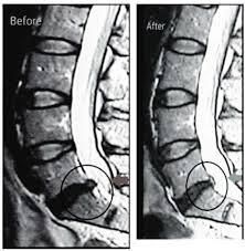 A black and white image of a person 's spine before and after surgery.