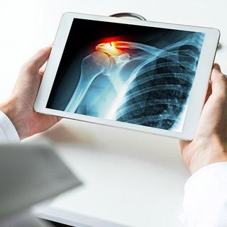 X-ray of Broken Shoulder | San Antonio, TX | Frank Schroeder, DO - Creedmoor Orthopedics