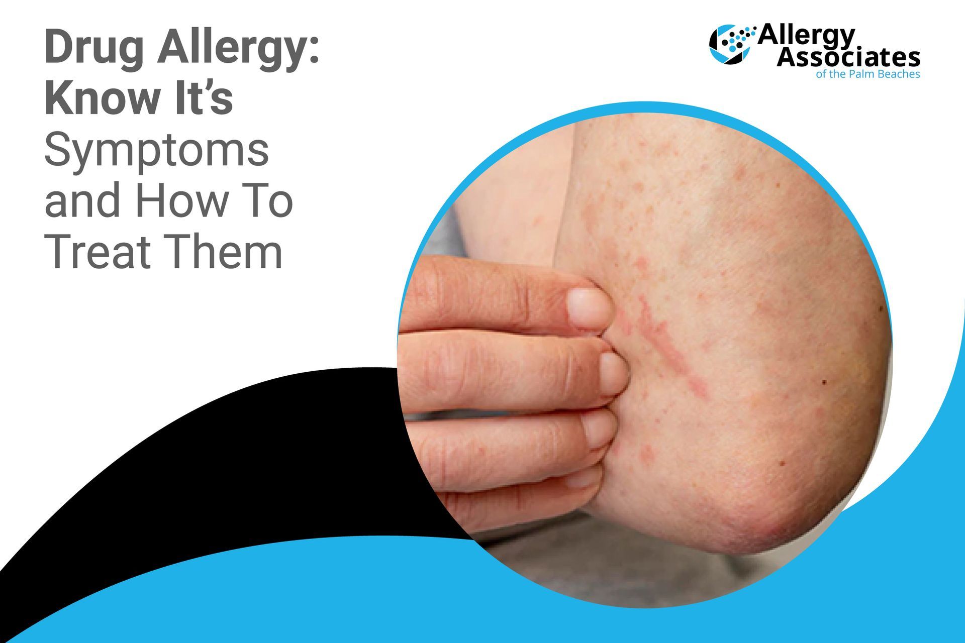 drug-allergy-know-its-symptoms-and-how-to-treat-them