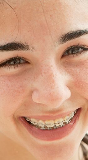 A close up of a woman with braces on her teeth smiling.