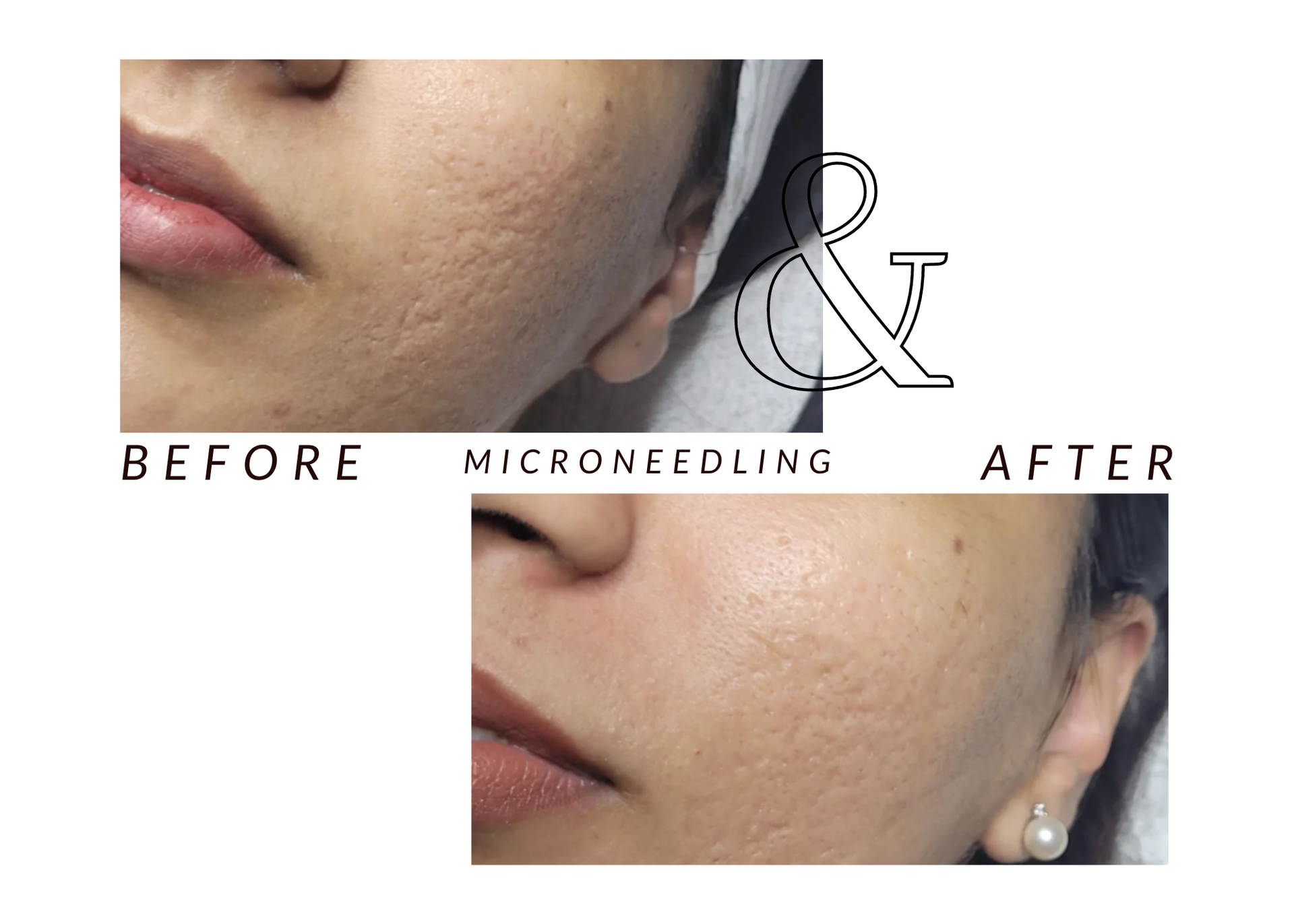 A woman 's face before and after microneedling.