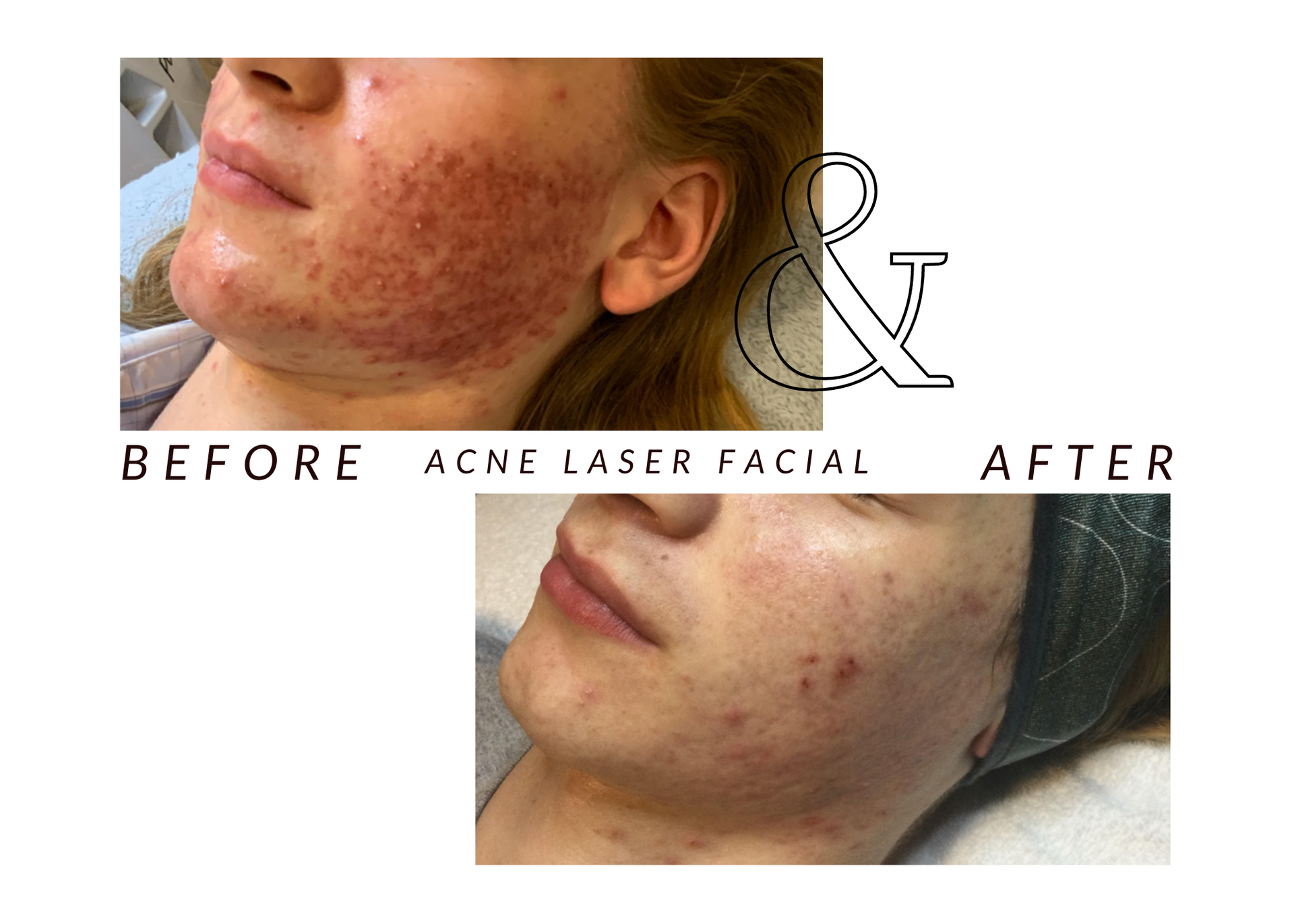 A before and after photo of a woman 's face with acne