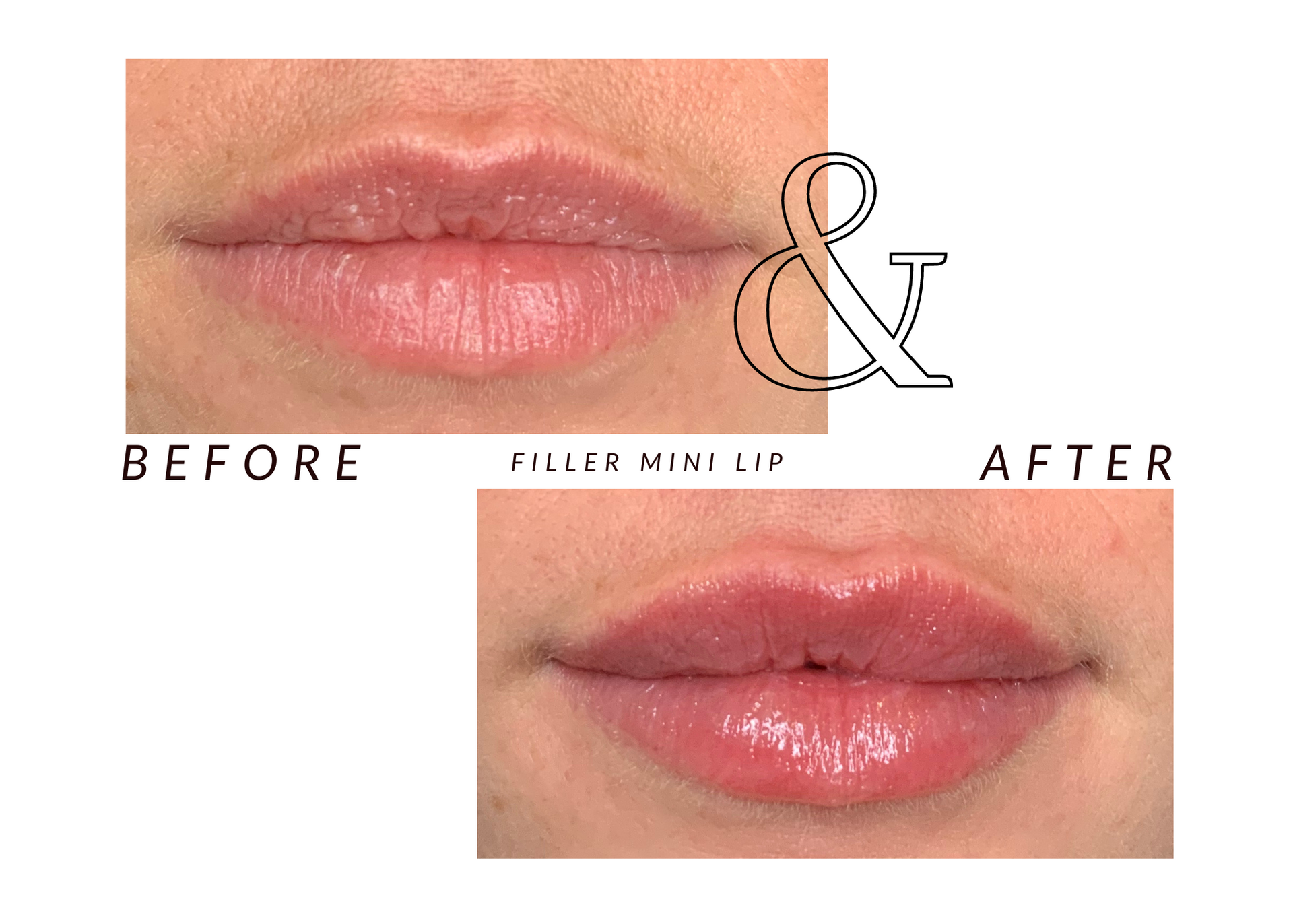 A picture of a woman 's lips before and after filler full lip enlargement