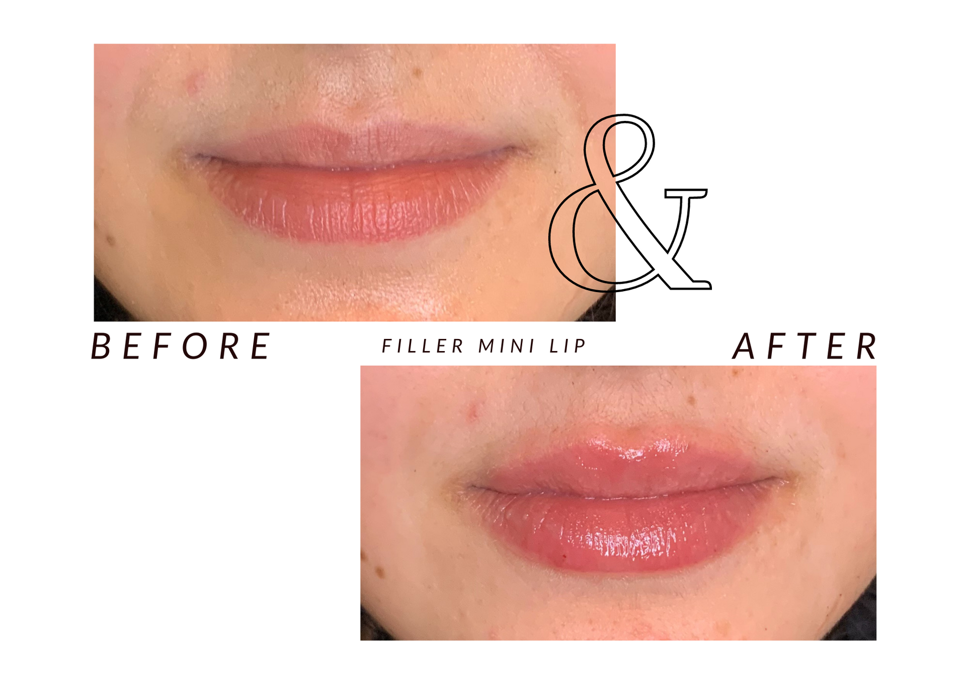 A picture of a woman 's lips before and after filler full lip enlargement