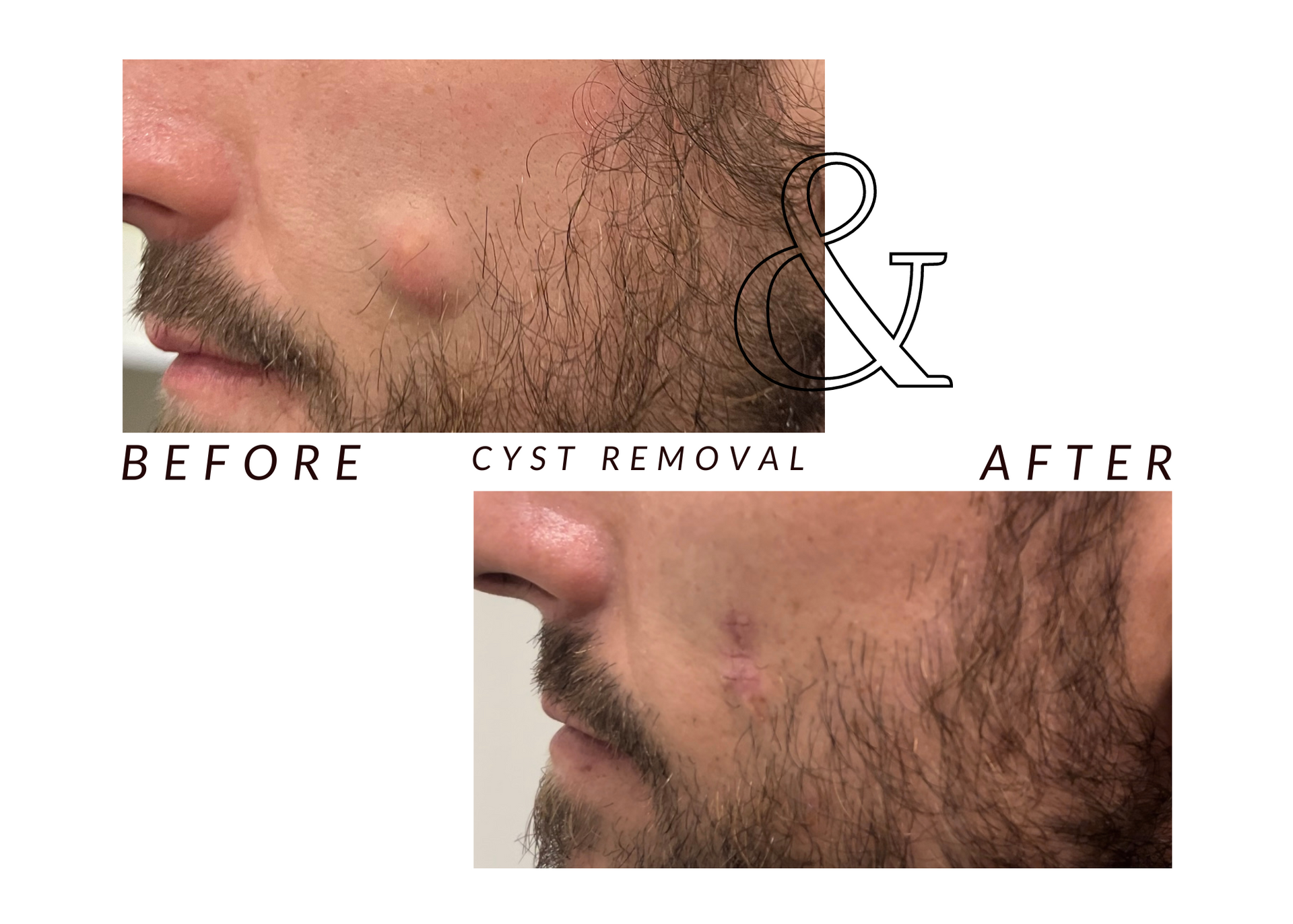 A man with a beard has a cyst removed from his face.