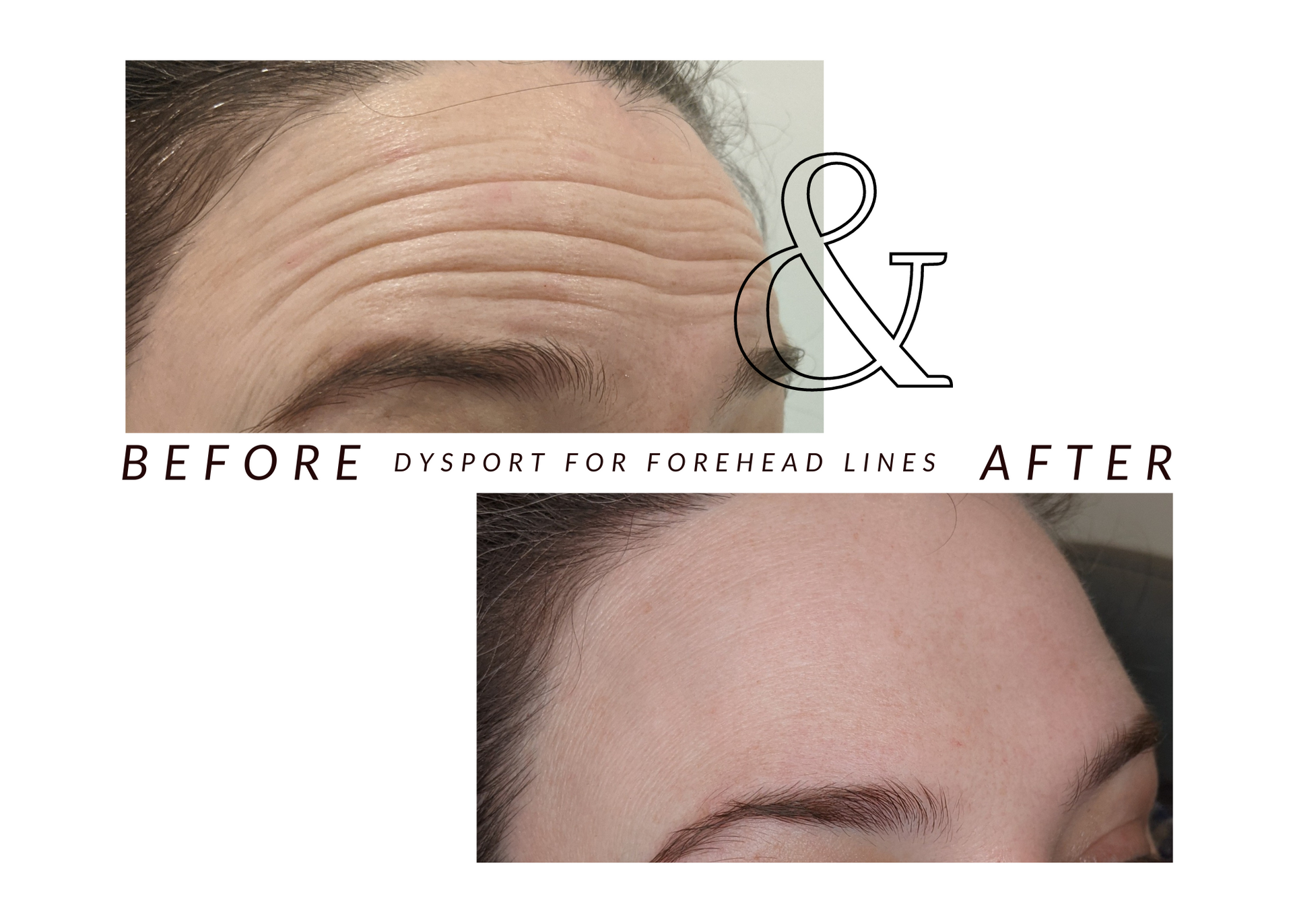 A before and after photo of a woman 's forehead lines