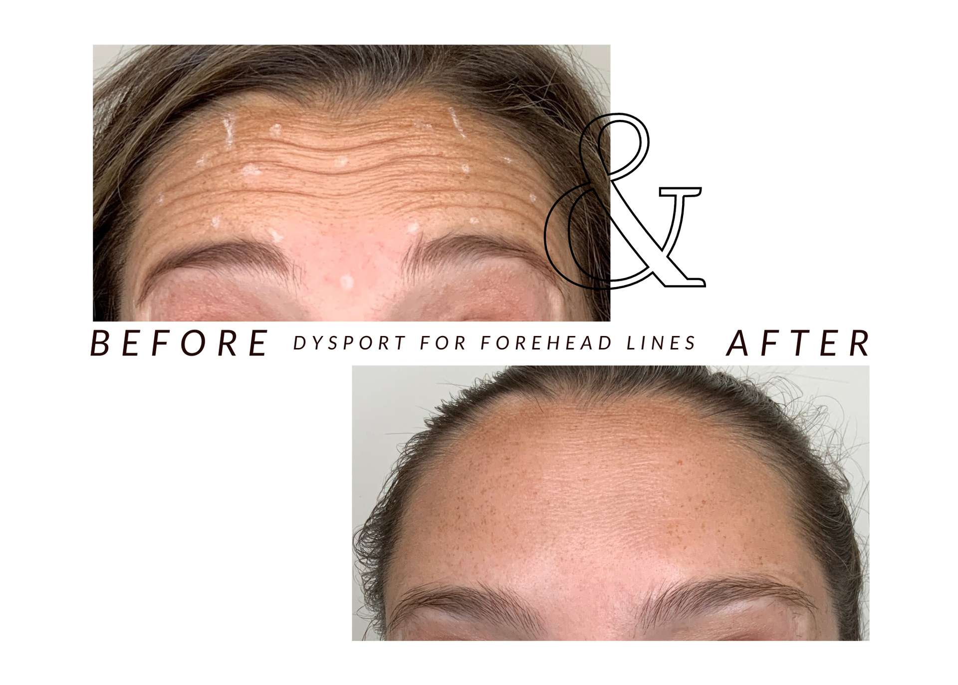 A before and after photo of a woman 's forehead lines.