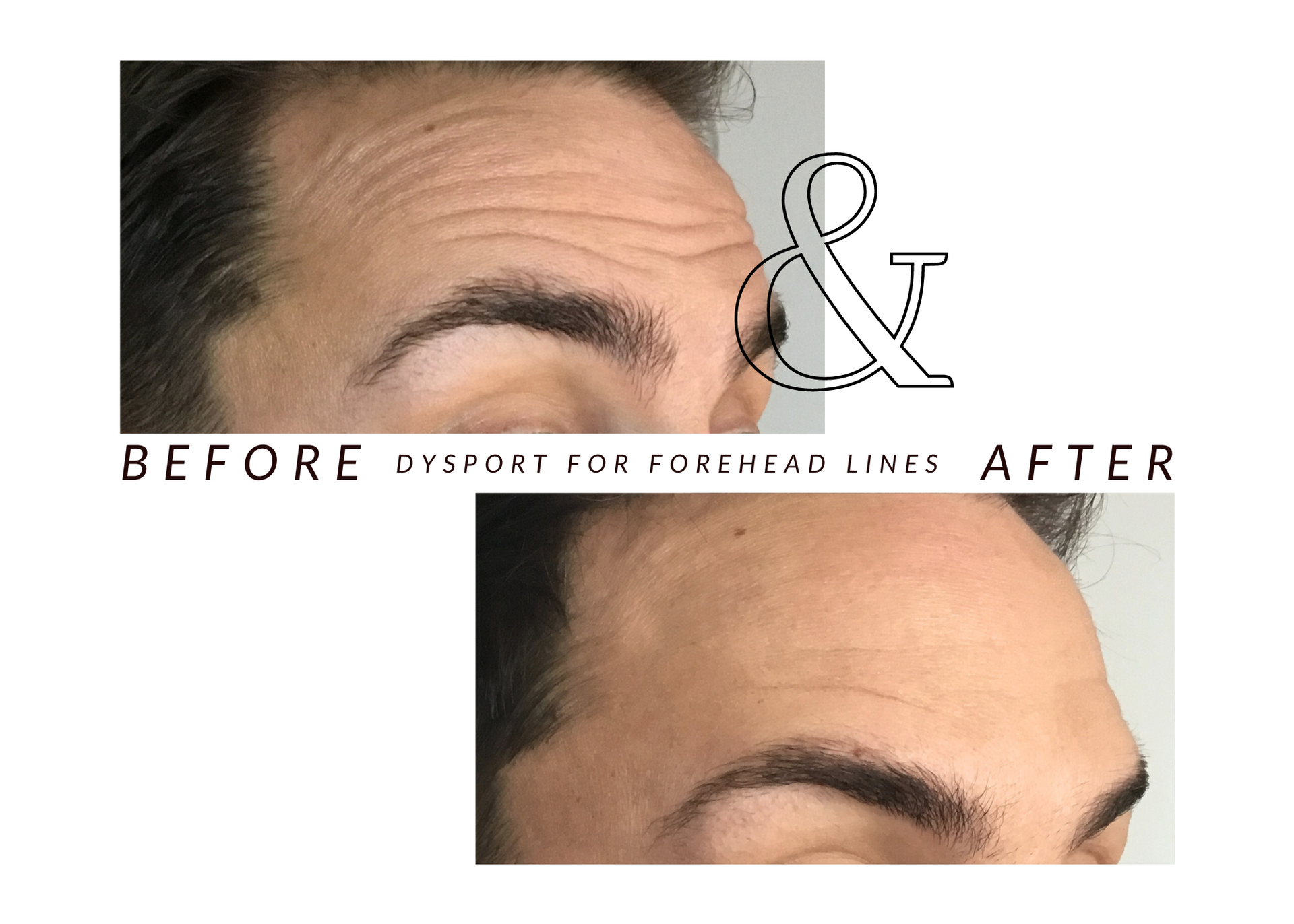 A before and after photo of a man 's forehead lines