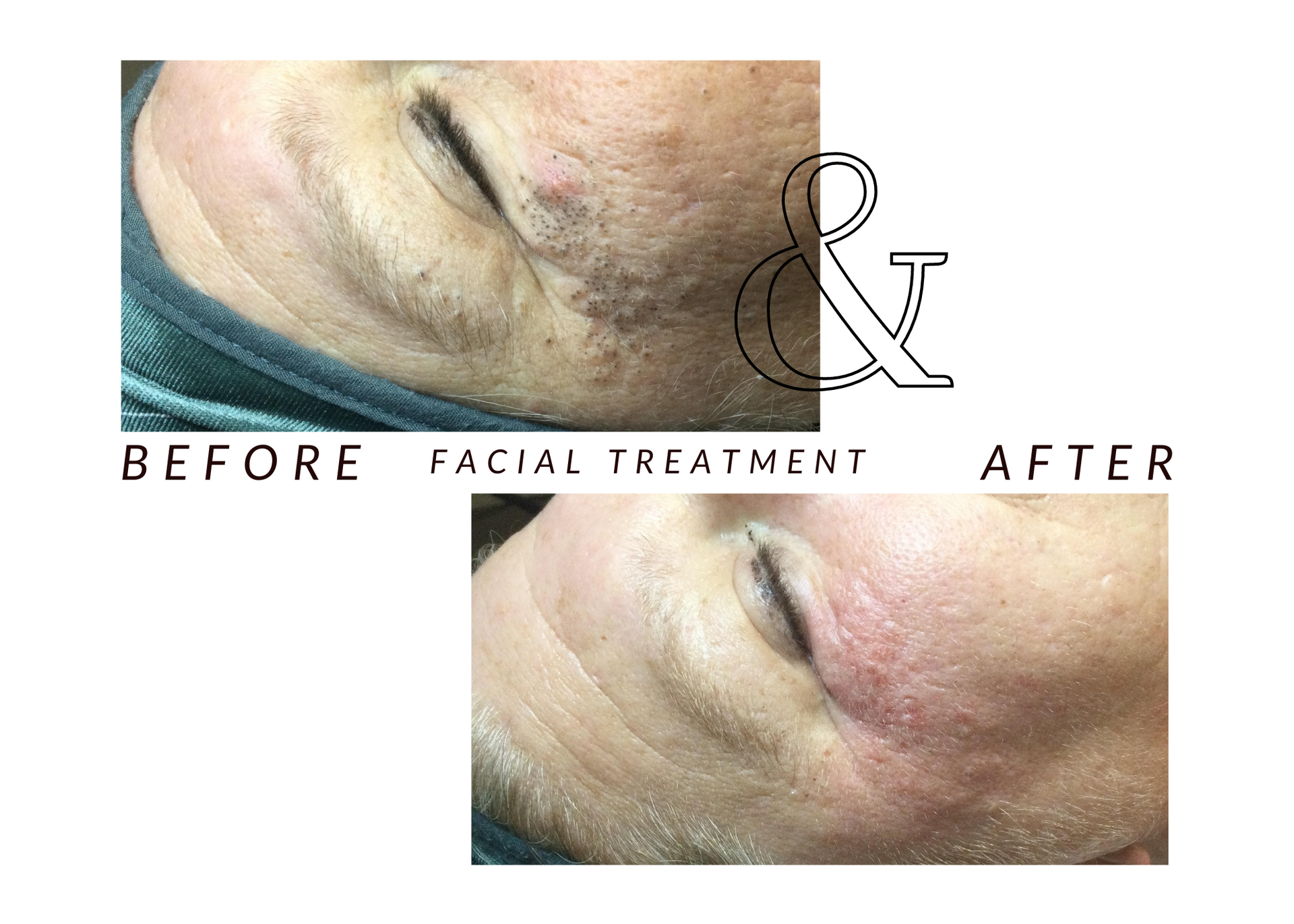 A person 's face before and after facial treatment.