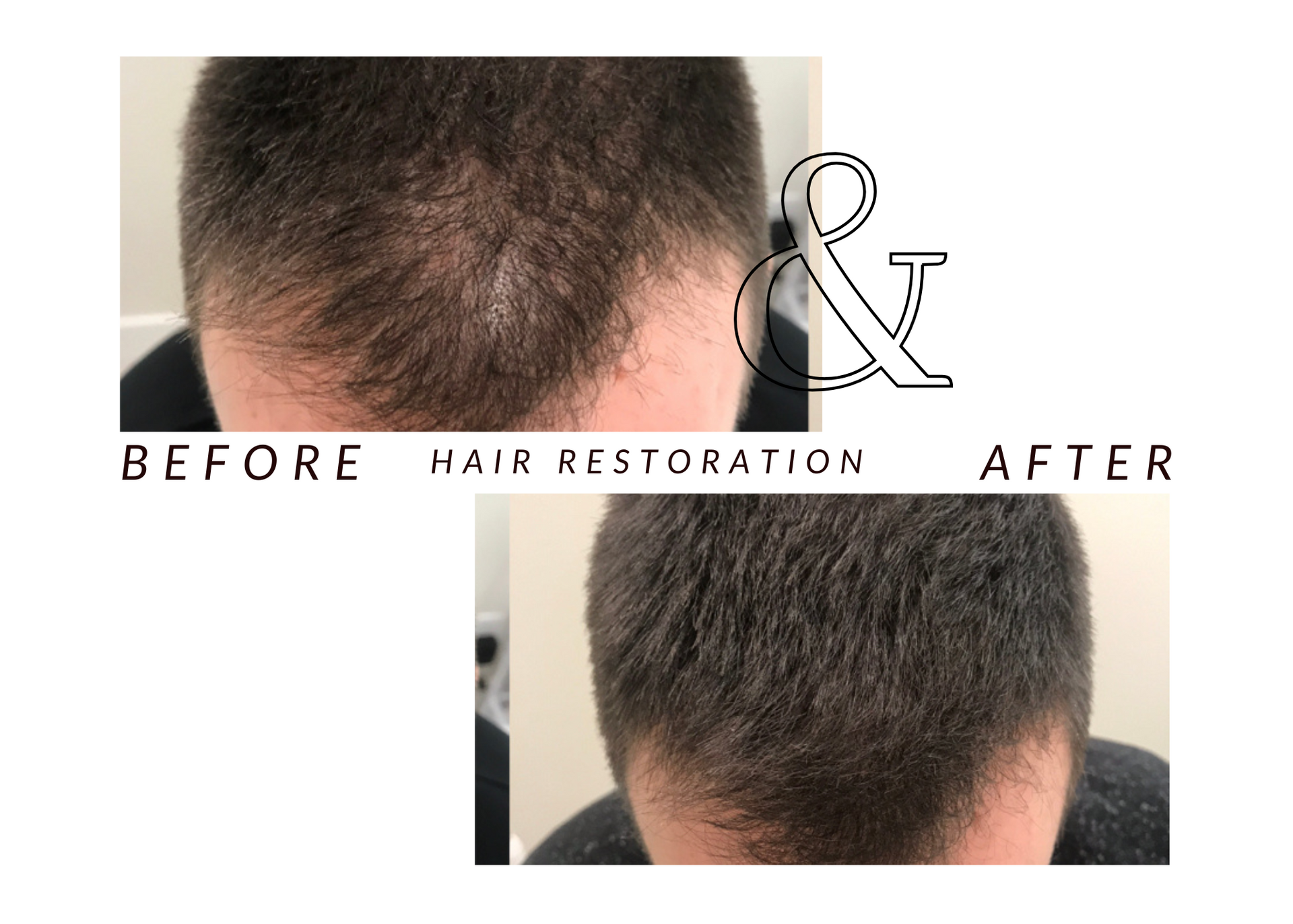 A before and after photo of a man 's hair restoration.