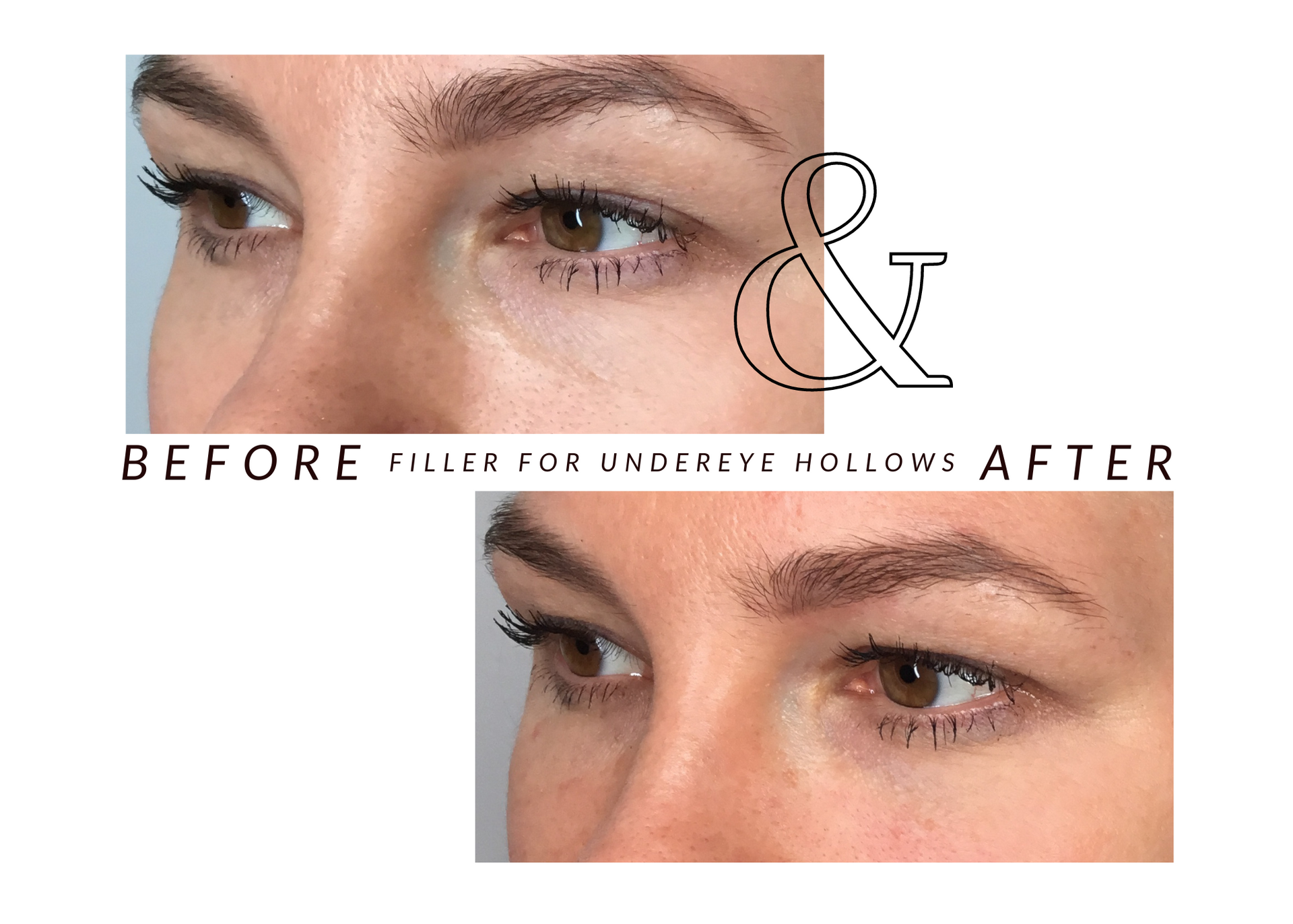 A before and after picture of a woman 's eye with filler for under eye hollow