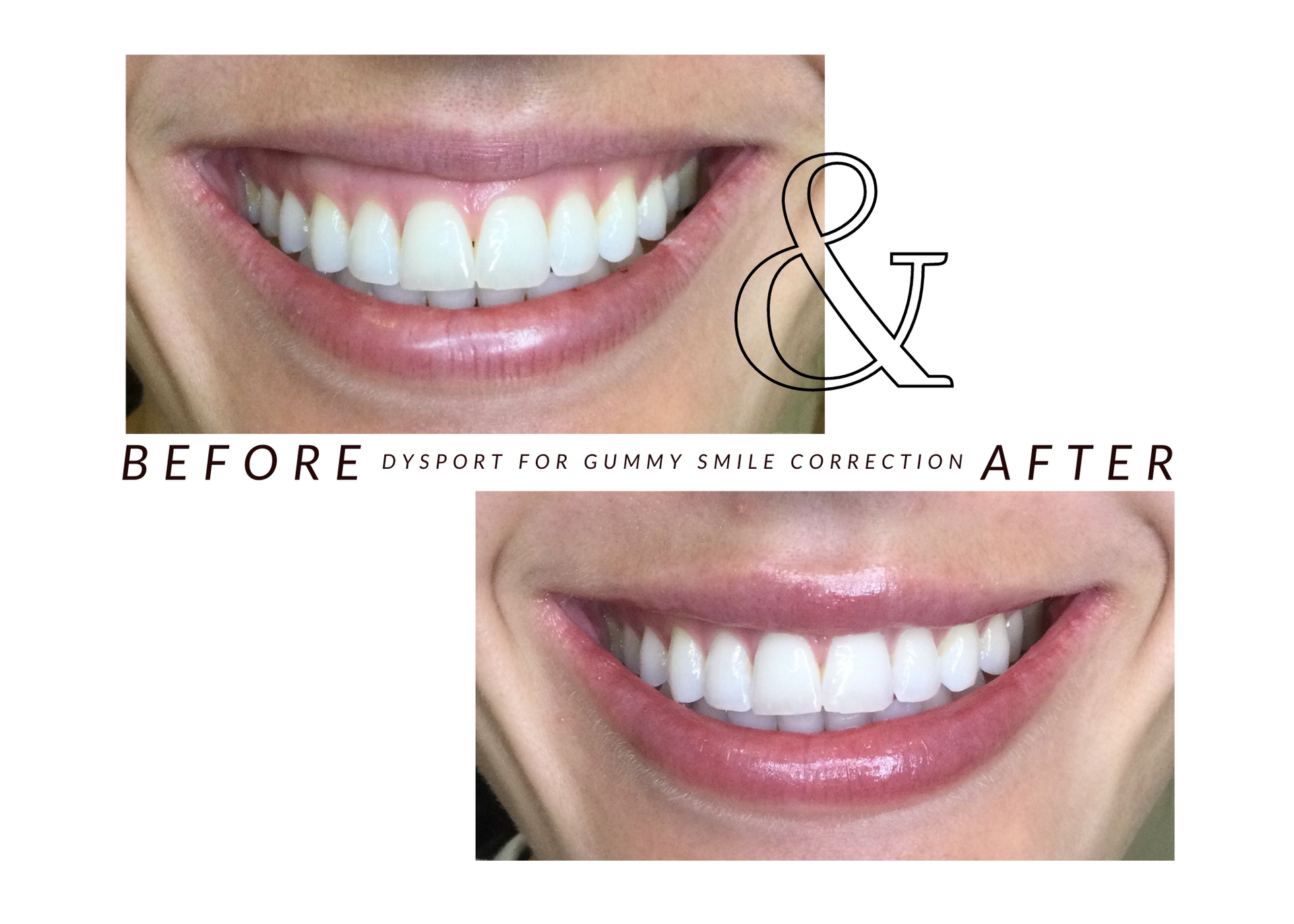 A before and after photo of a woman 's smile