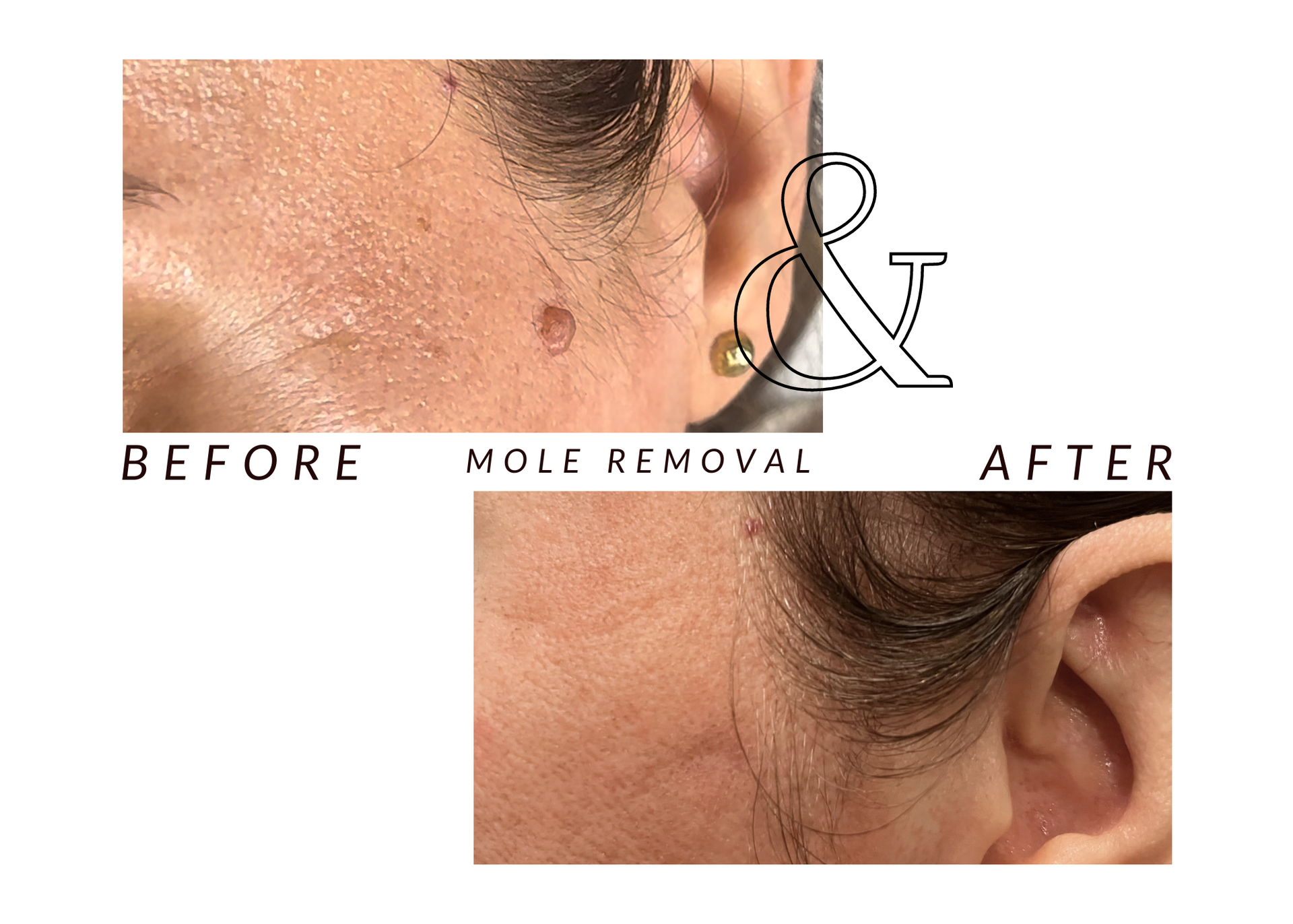 A before and after picture of a woman 's mole removal.