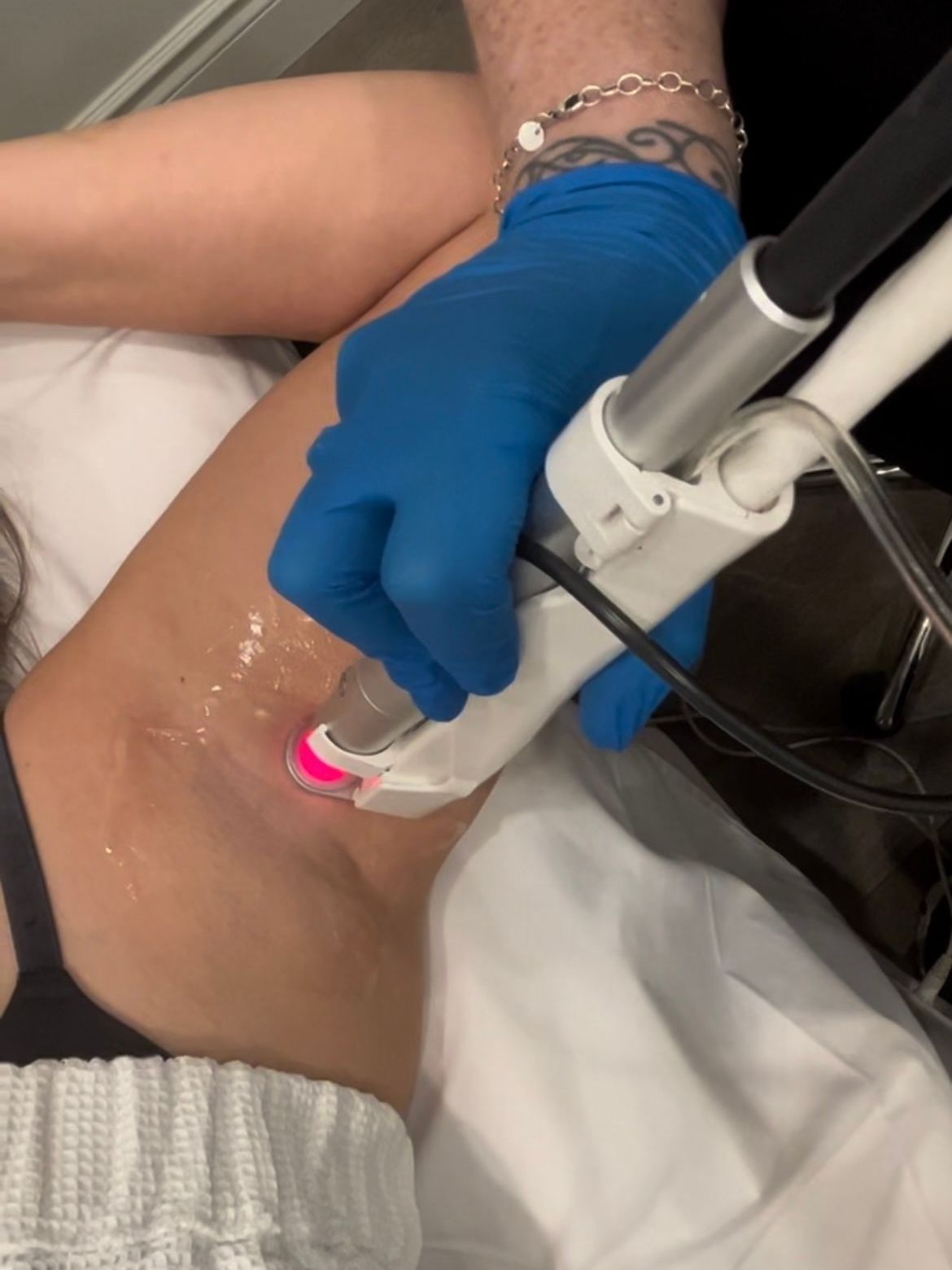 A woman is getting a laser hair removal treatment on her underarm.