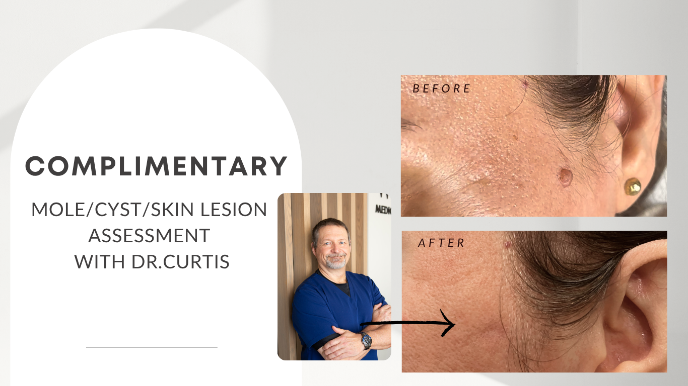 The sale you 've wanted save big on microneedling and laser