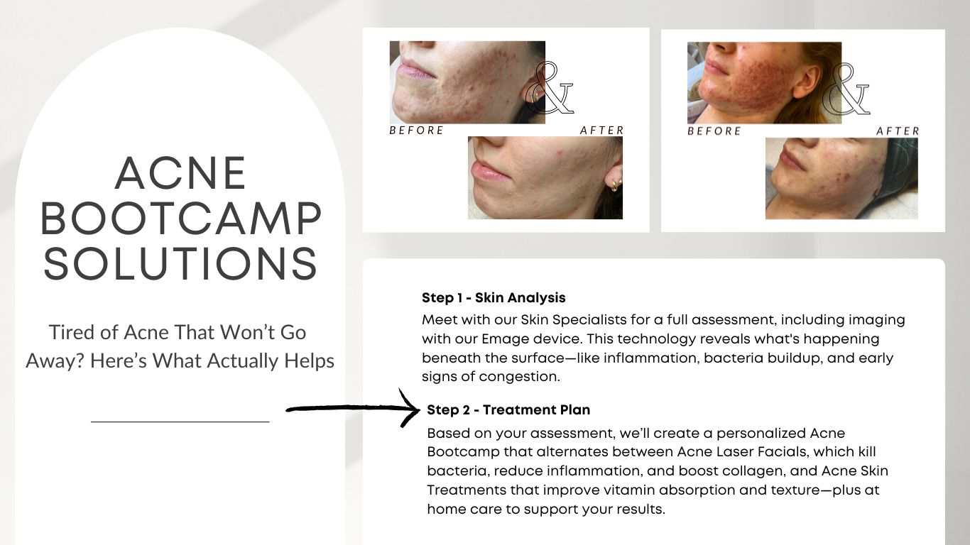 The sale you 've wanted save big on microneedling and laser
