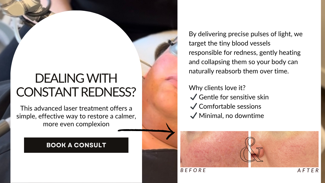 Promotional skincare graphic for constant redness with before-and-after cheek images and a “Book a consult” button
