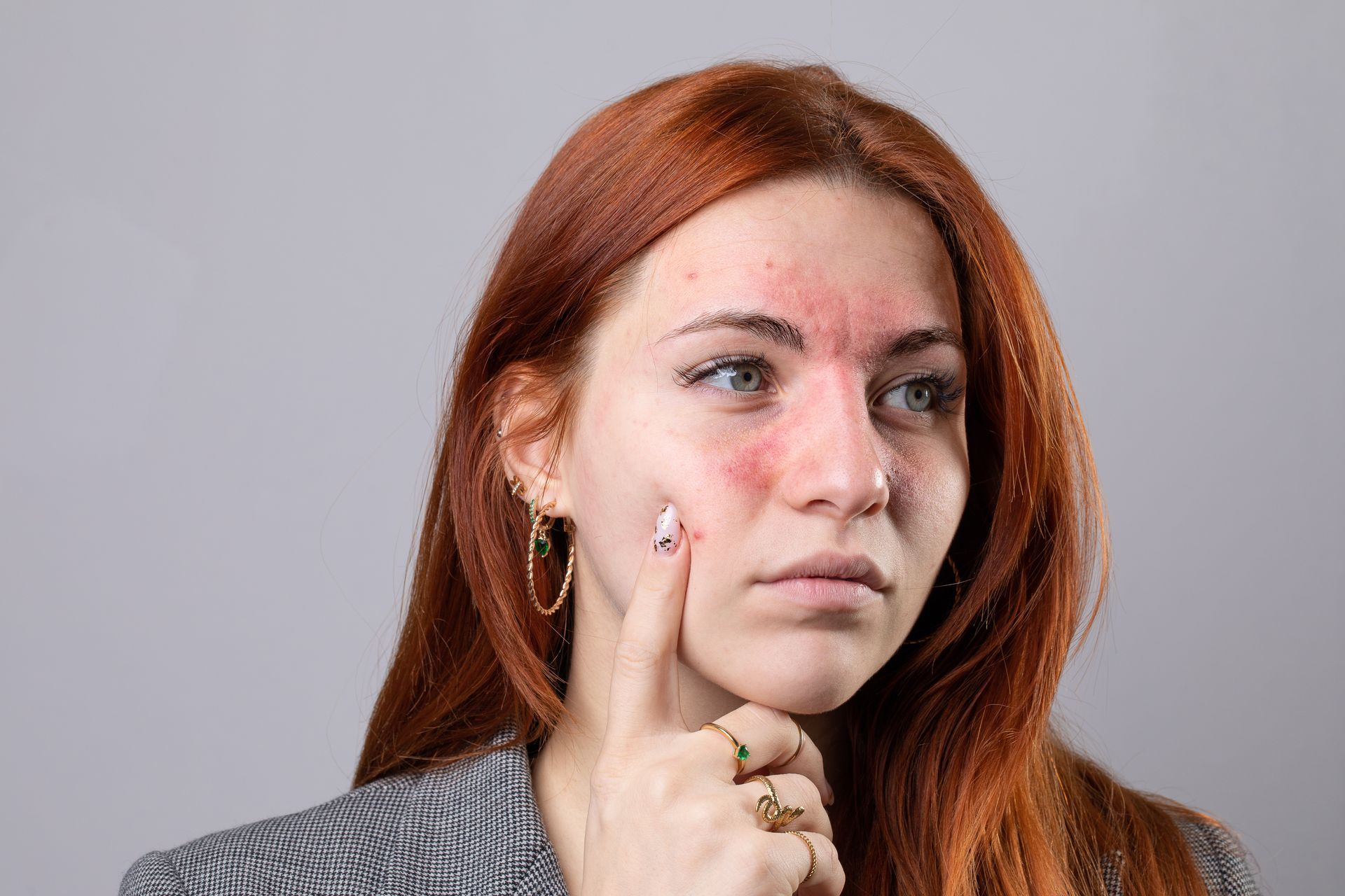 A woman with red hair has a rash on her face.