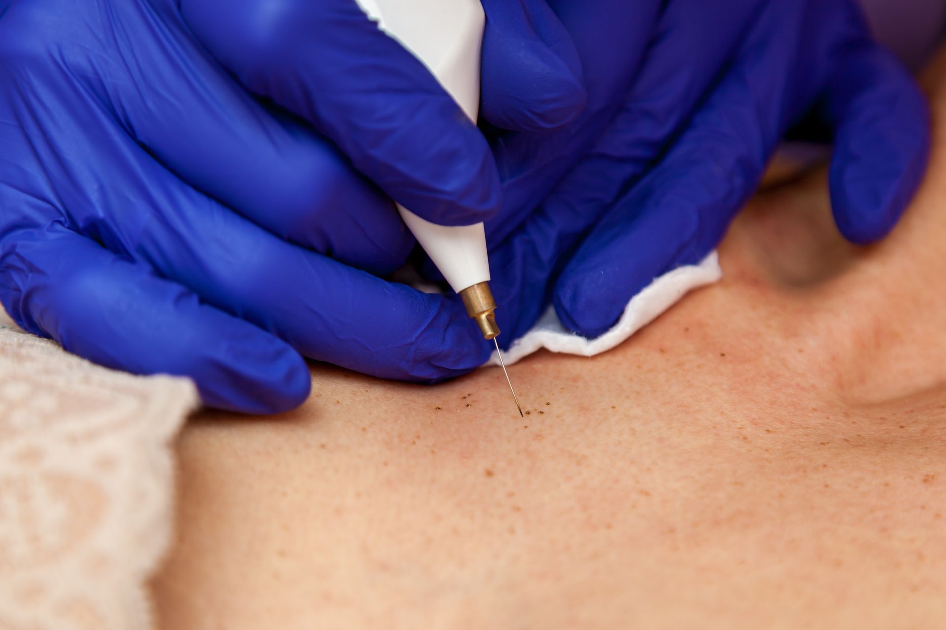 A person wearing blue gloves is using a pen on a person 's skin.